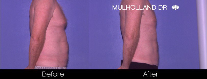 Liposuction -Before and After Gallery - Patient Photo 80