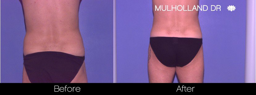 Liposuction -Before and After Gallery - Patient Photo 84