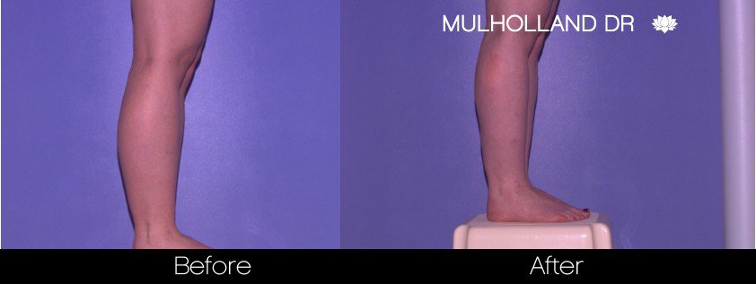 Liposuction -Before and After Gallery - Patient Photo 87
