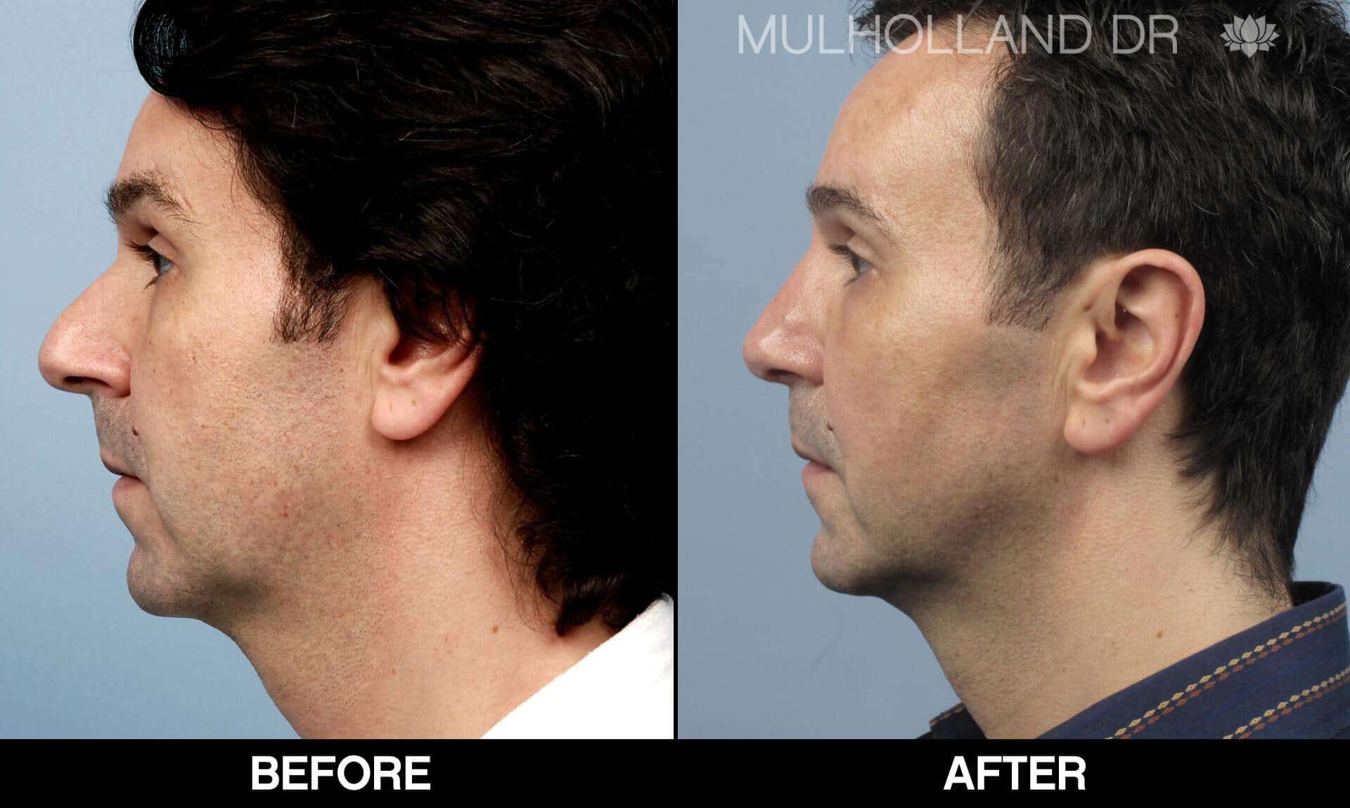 Male Rhinoplasty - Before and After Gallery - Patient Photo 1