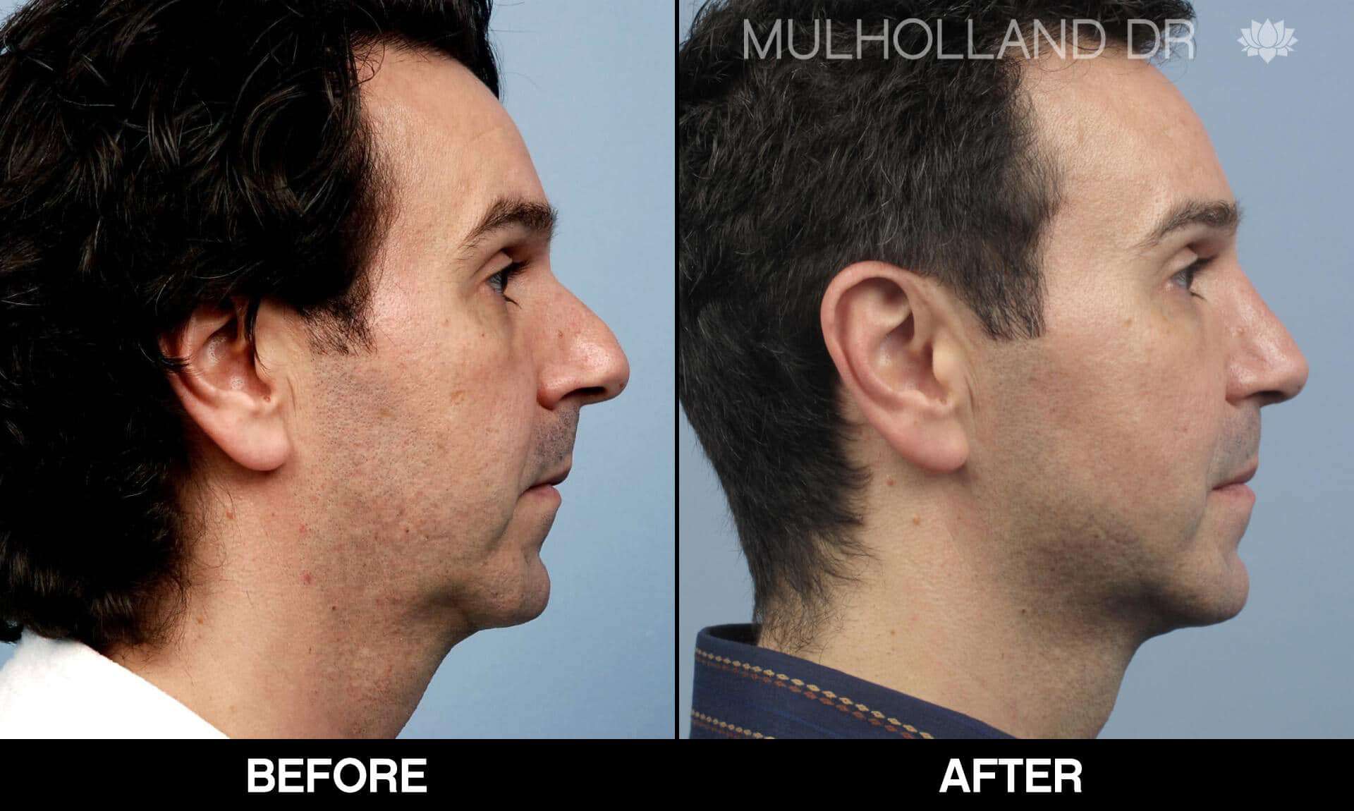 Male Rhinoplasty - Before and After Gallery - Patient Photo 2