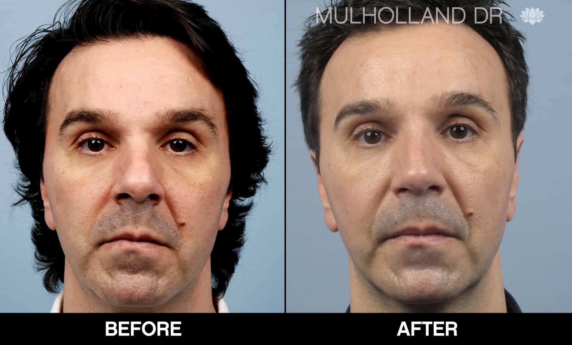 Male Rhinoplasty - Before and After Gallery - Patient Photo 3