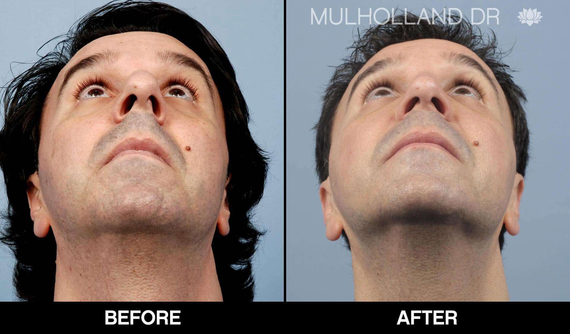 Male Rhinoplasty - Before and After Gallery - Patient Photo 4
