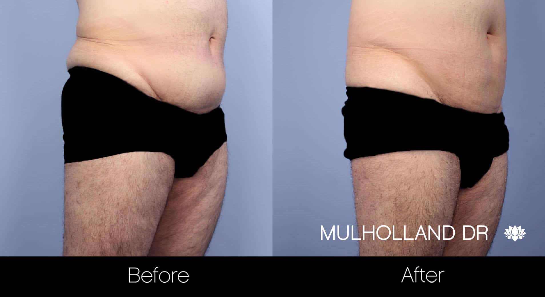 Male Tummy Tuck - Before and After Gallery - Patient Photo 10