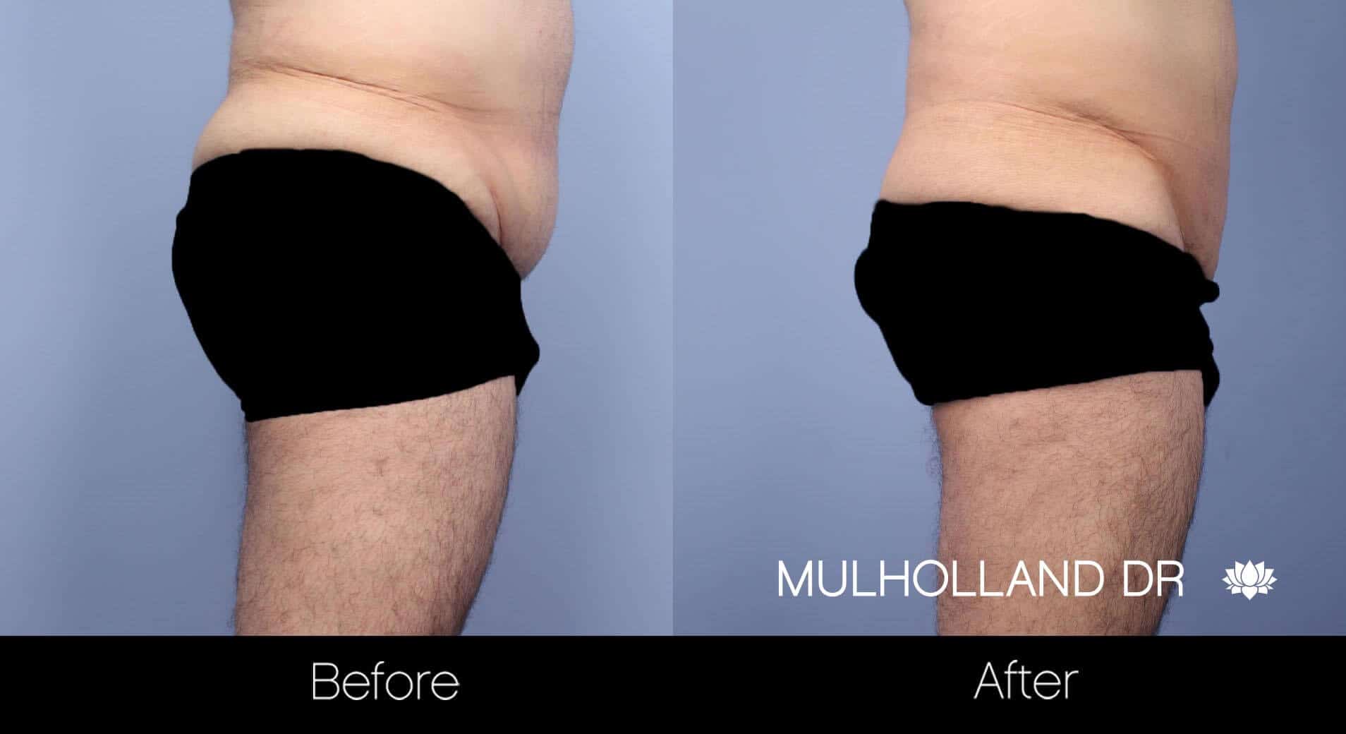 Male Tummy Tuck - Before and After Gallery - Patient Photo 11