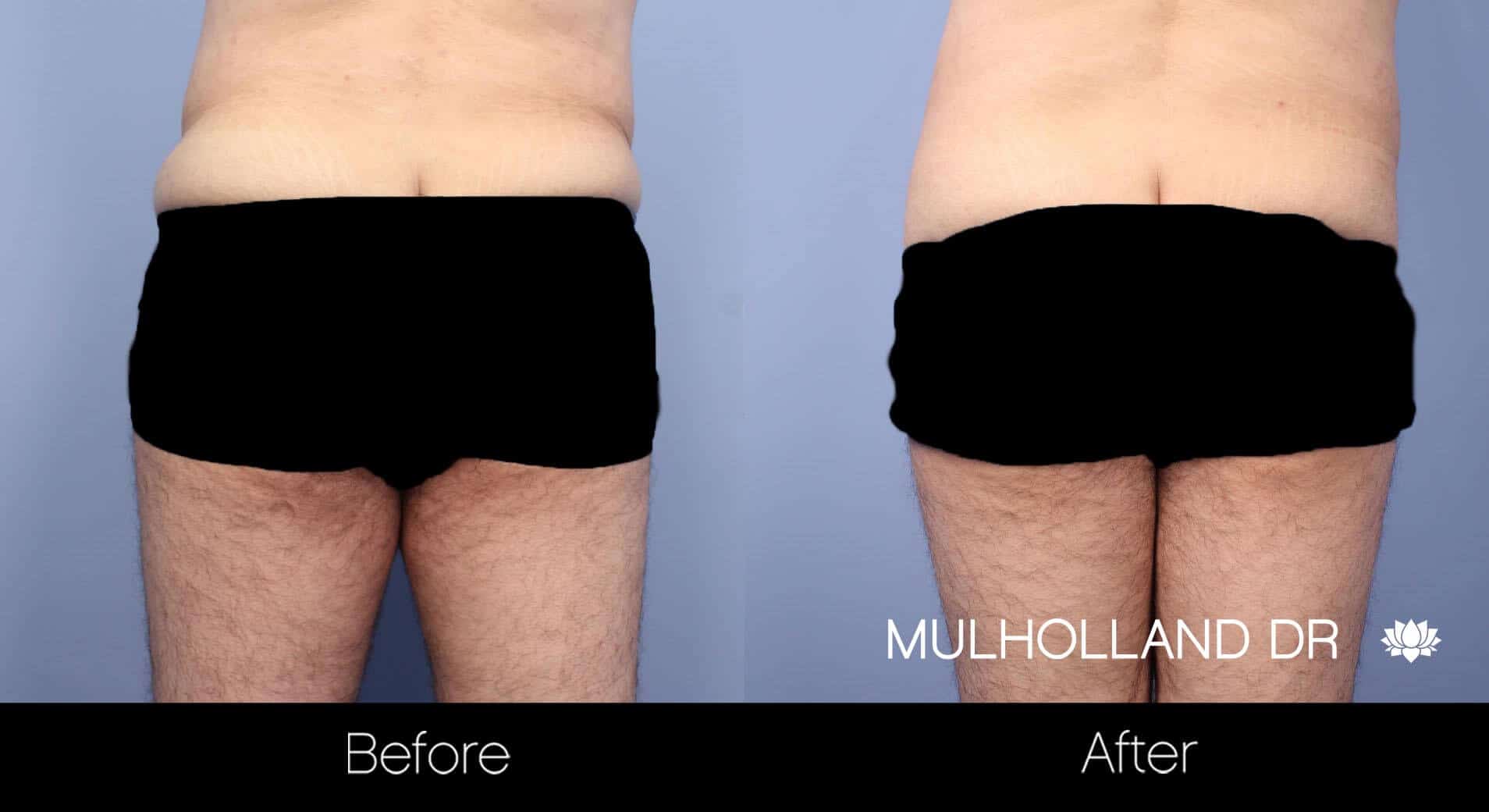 Male Tummy Tuck - Before and After Gallery - Patient Photo 12