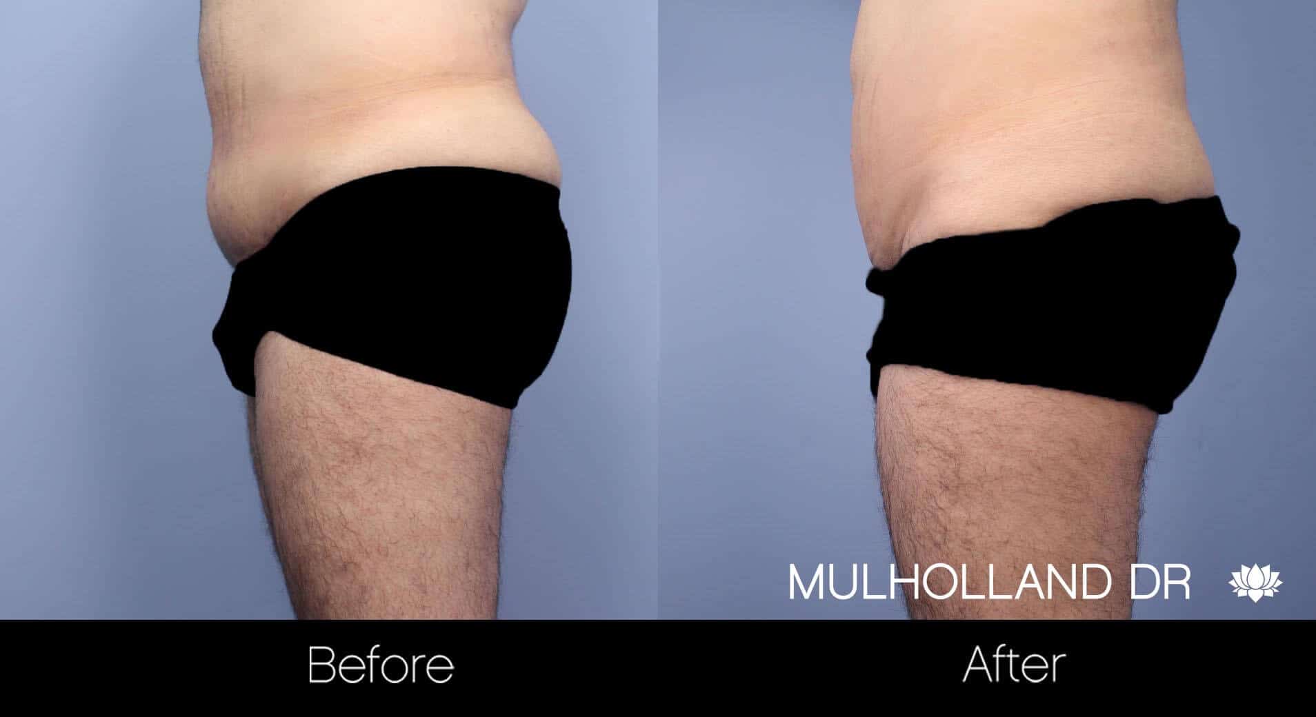 Male Tummy Tuck - Before and After Gallery - Patient Photo 13