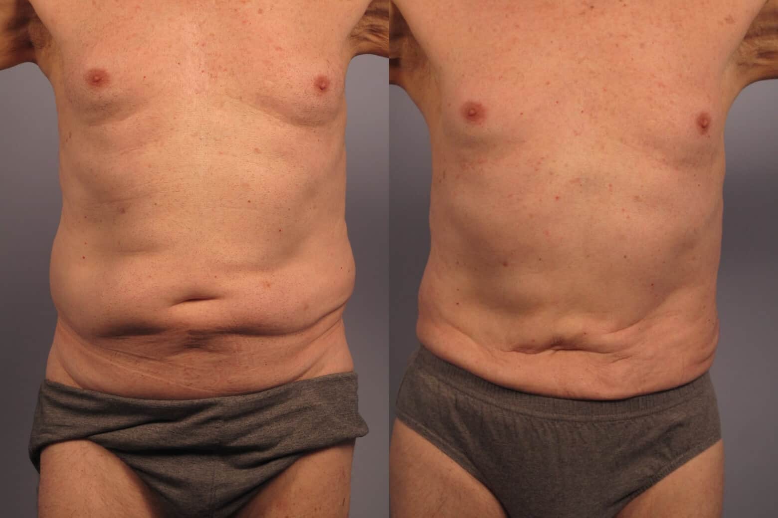 Male Tummy Tuck - Before and After Gallery - Patient Photo 15