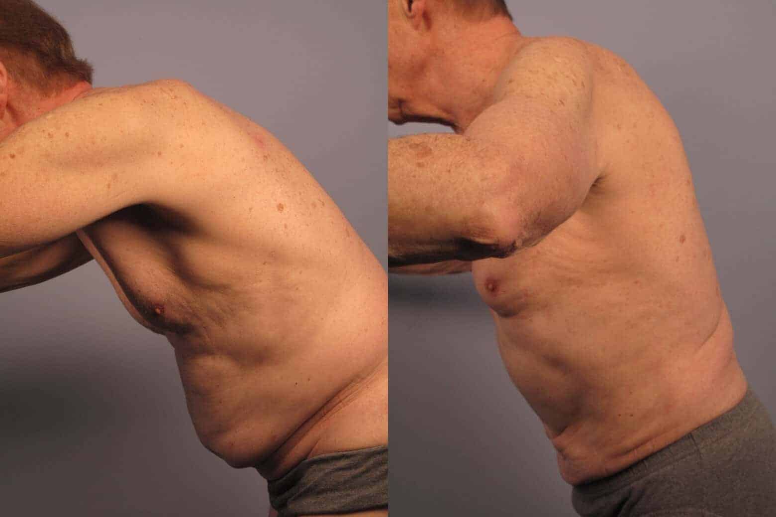 Male Tummy Tuck - Before and After Gallery - Patient Photo 16