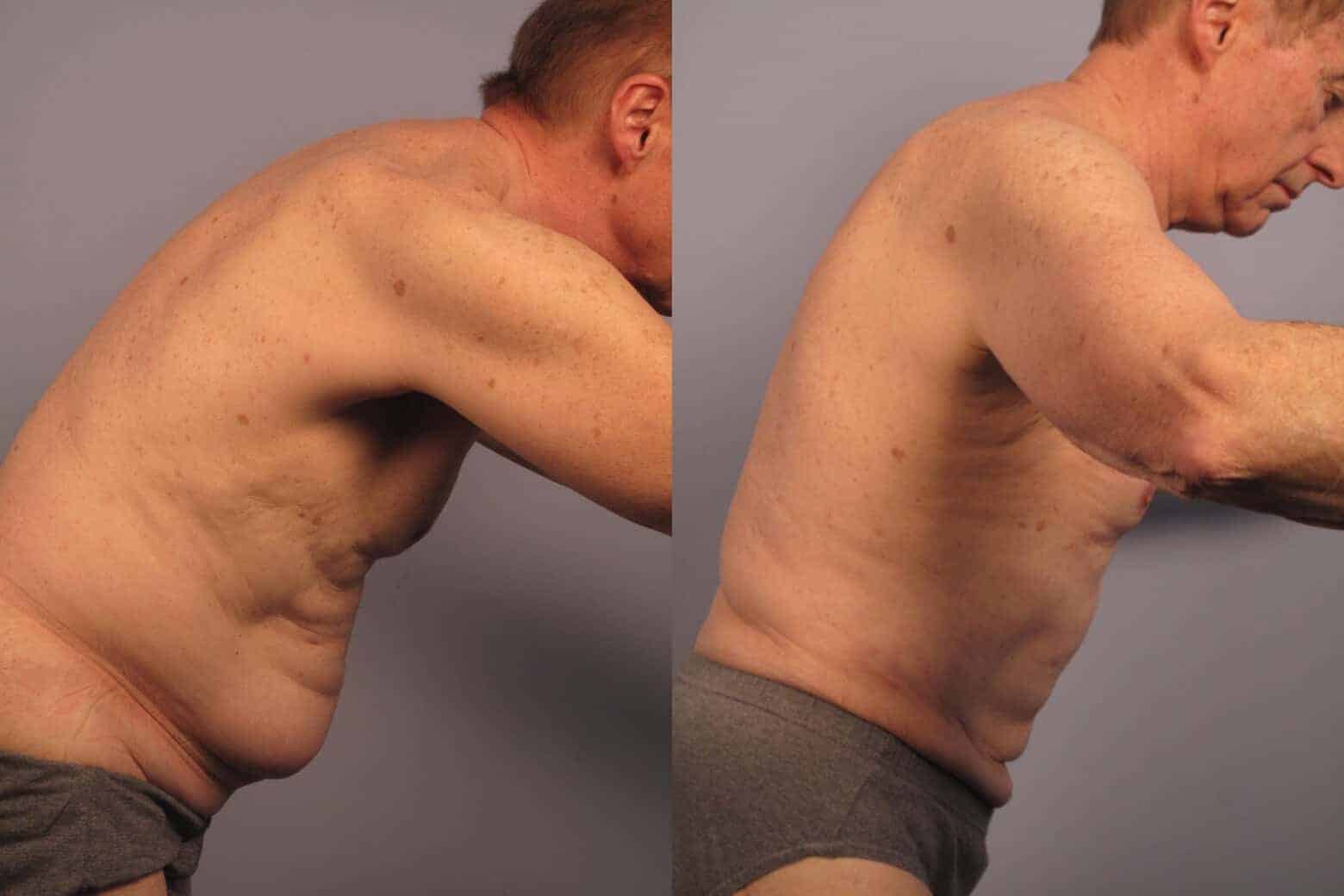 Male Tummy Tuck - Before and After Gallery - Patient Photo 17