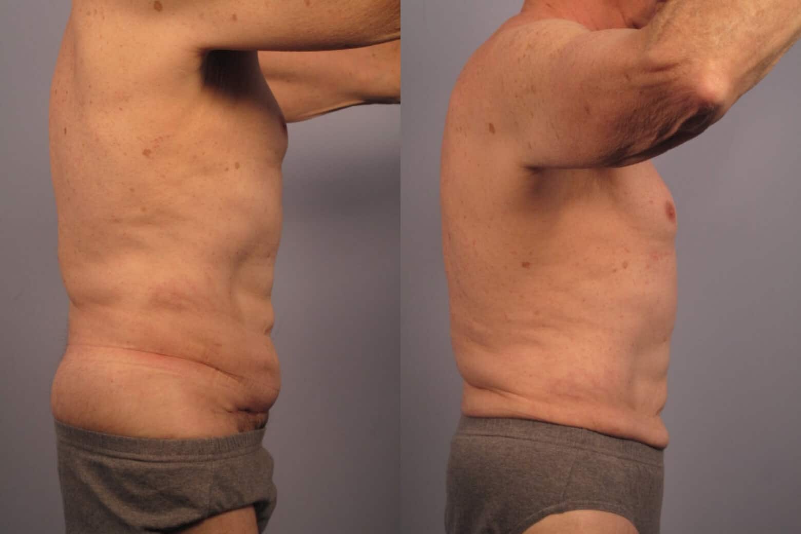 Male Tummy Tuck - Before and After Gallery - Patient Photo 19