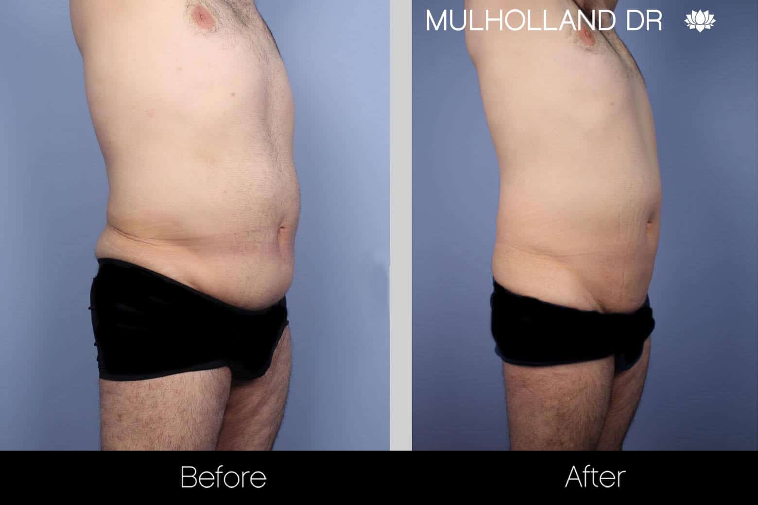 Male Tummy Tuck - Before and After Gallery - Patient Photo 2