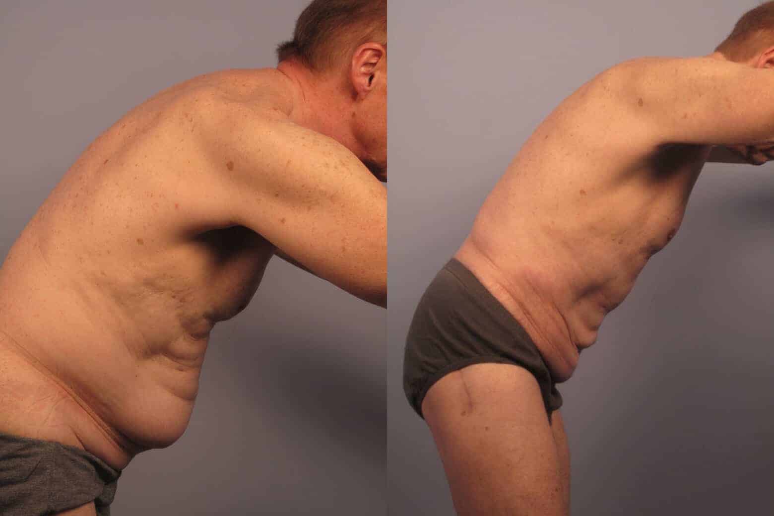 Male Tummy Tuck - Before and After Gallery - Patient Photo 20
