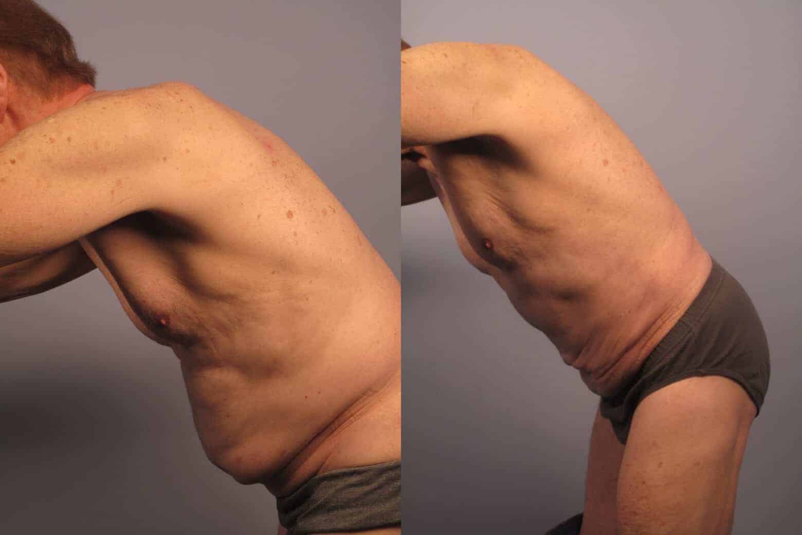 Male Tummy Tuck - Before and After Gallery - Patient Photo 21