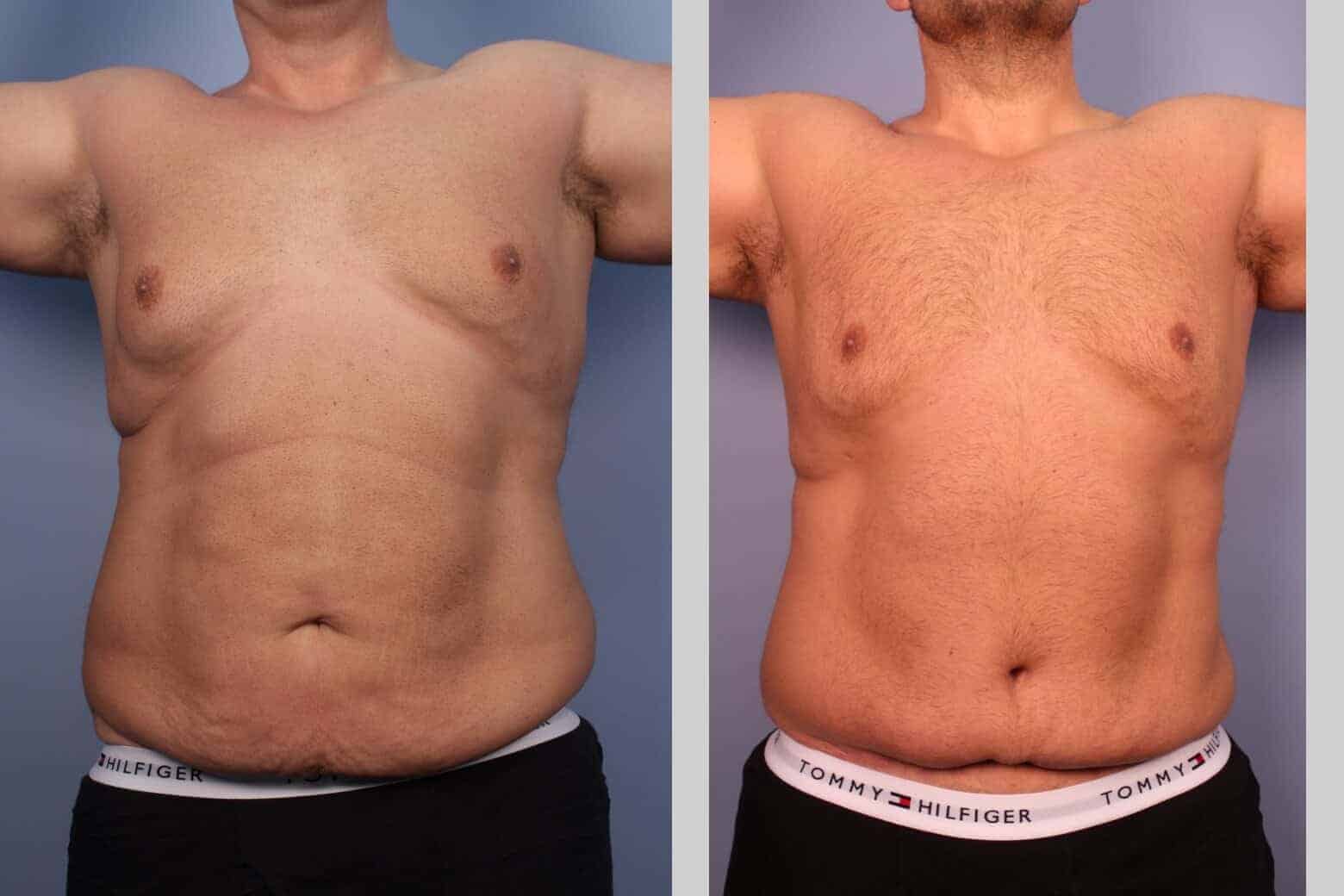 Male Tummy Tuck - Before and After Gallery - Patient Photo 22