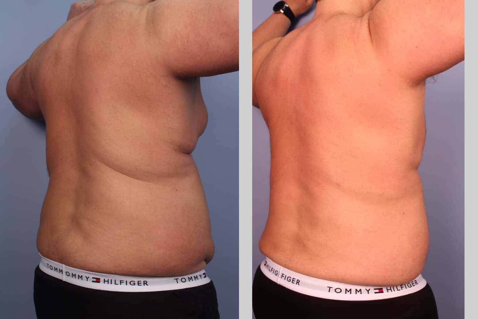 Male Tummy Tuck - Before and After Gallery - Patient Photo 25