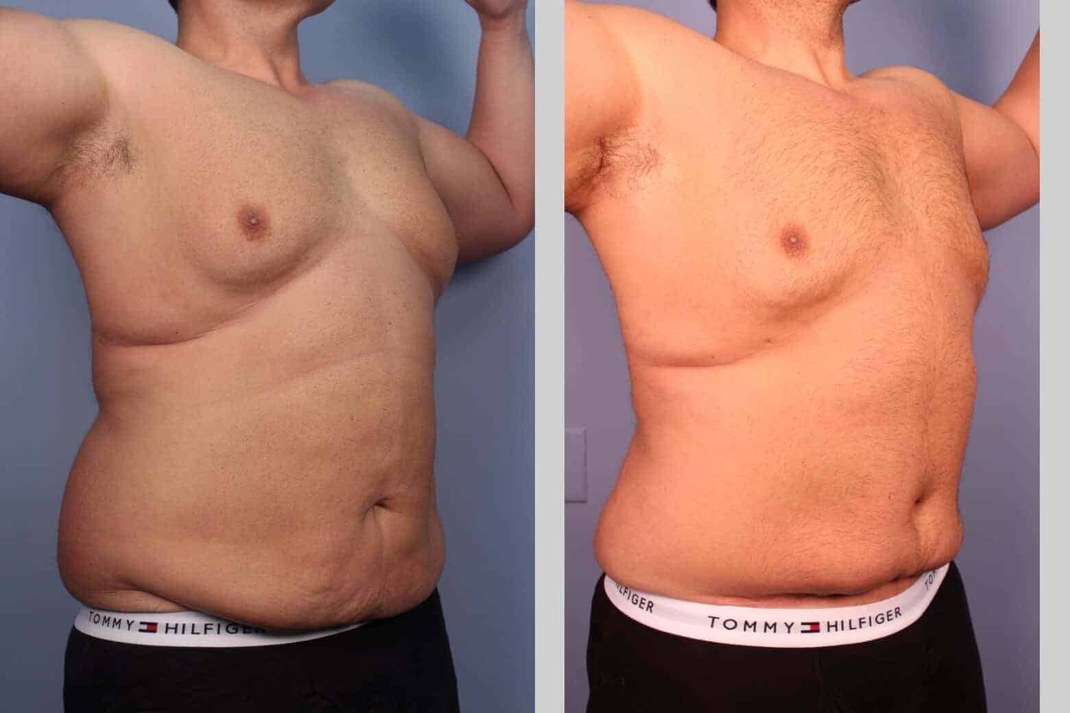 Male Tummy Tuck - Before and After Gallery - Patient Photo 27