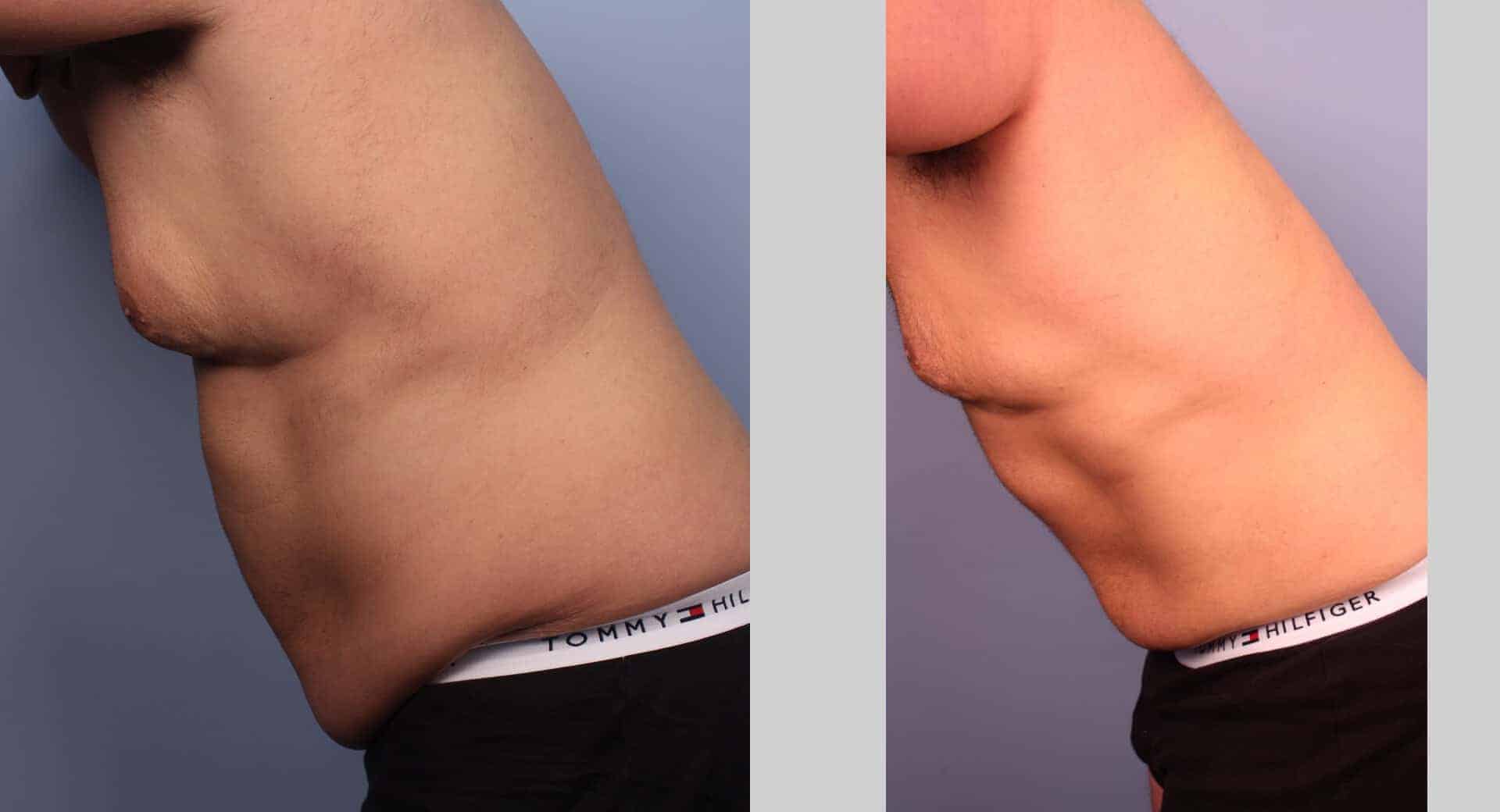 Male Tummy Tuck - Before and After Gallery - Patient Photo 29