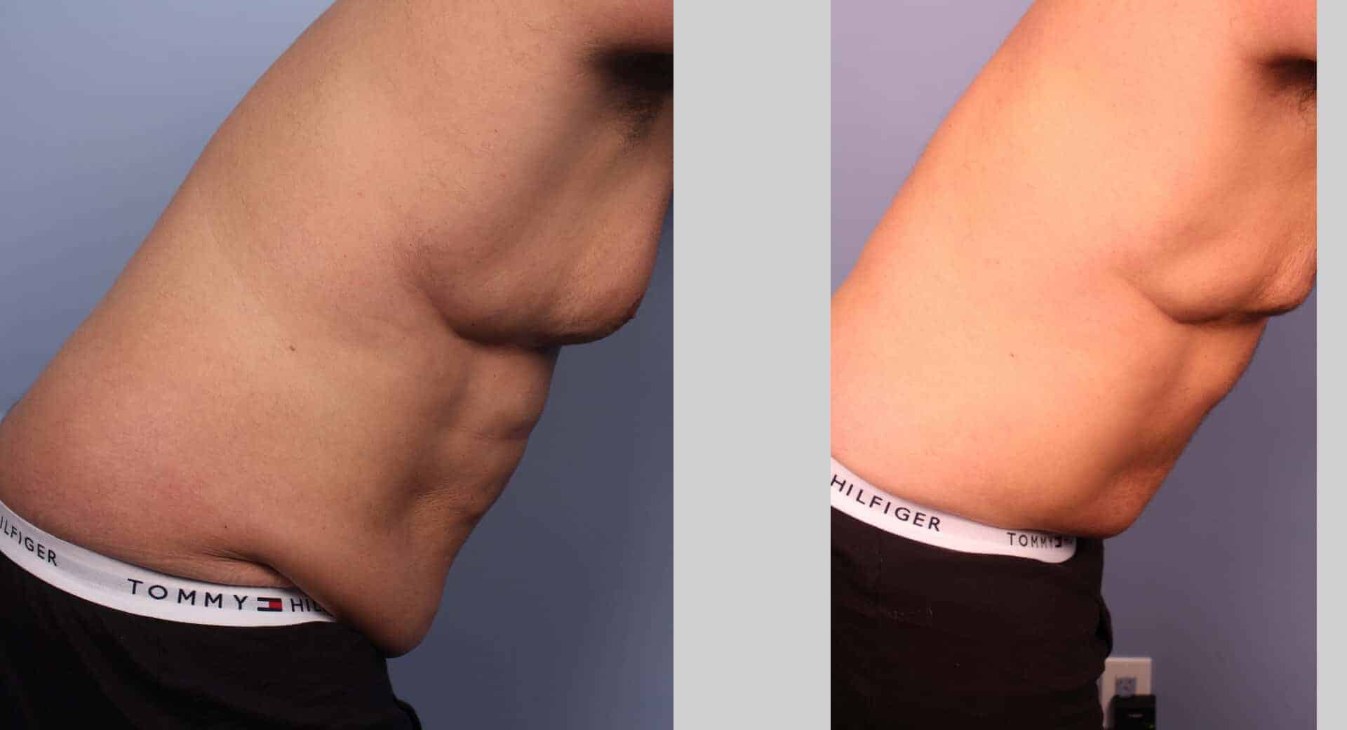 Male Tummy Tuck - Before and After Gallery - Patient Photo 30