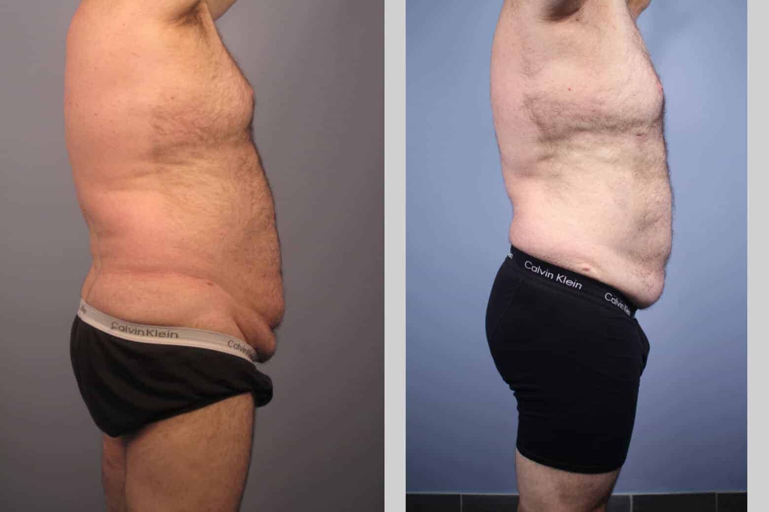 Male Tummy Tuck - Before and After Gallery - Patient Photo 31
