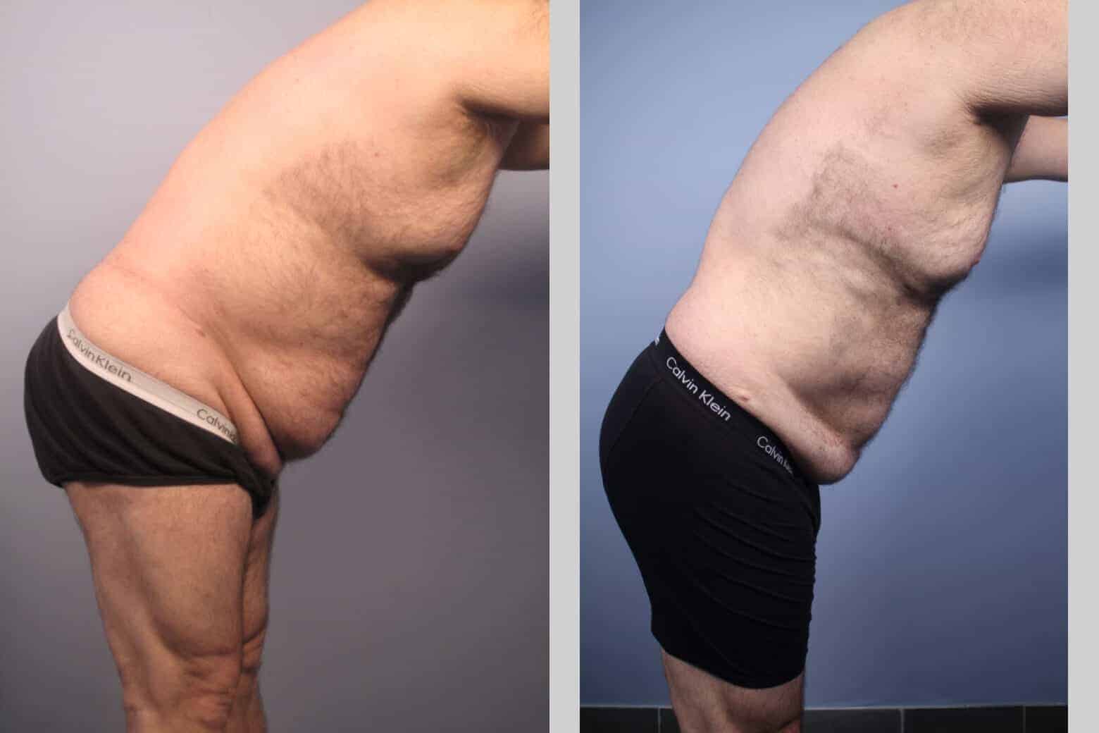Male Tummy Tuck - Before and After Gallery - Patient Photo 32