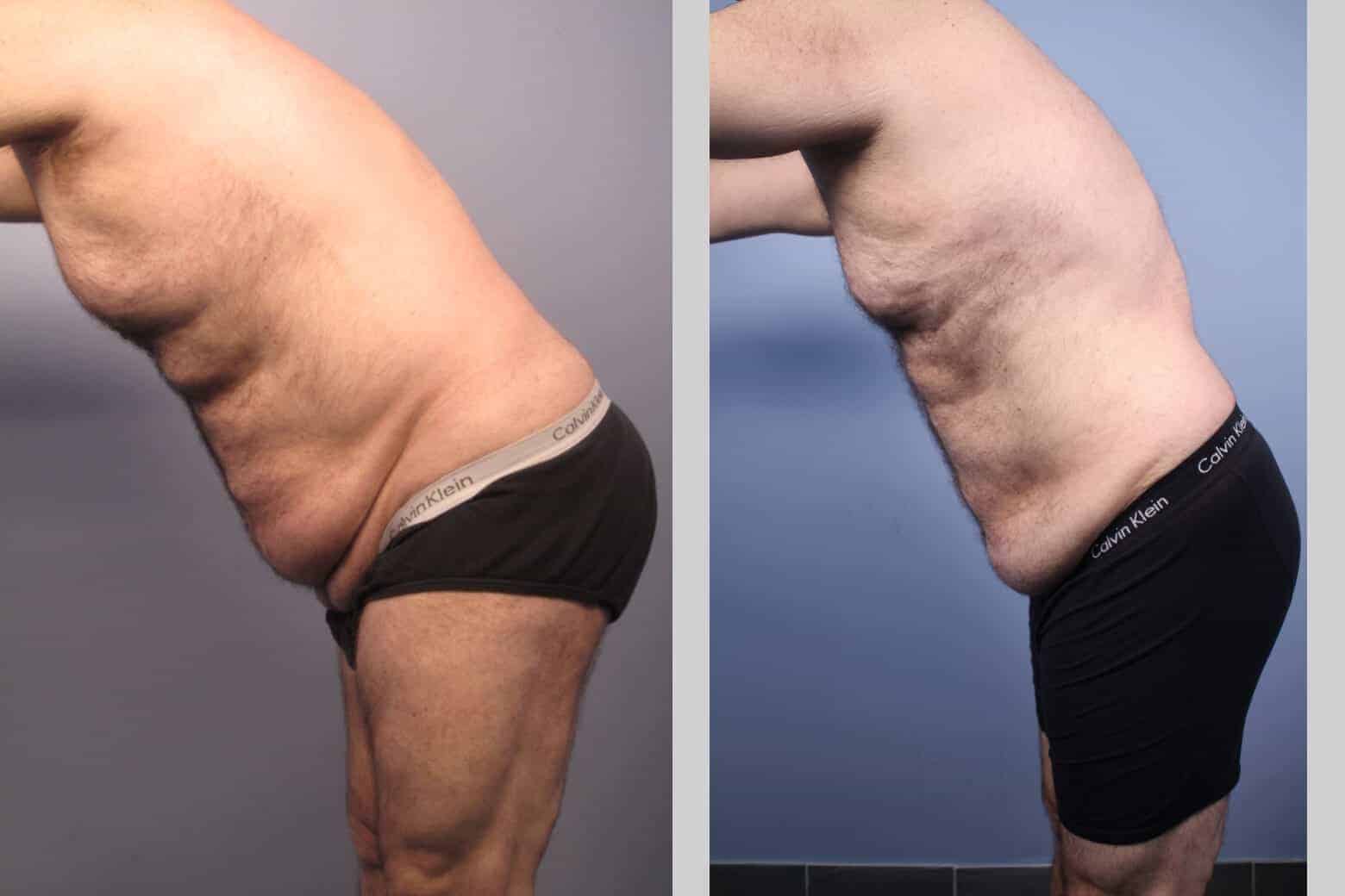 Male Tummy Tuck - Before and After Gallery - Patient Photo 33