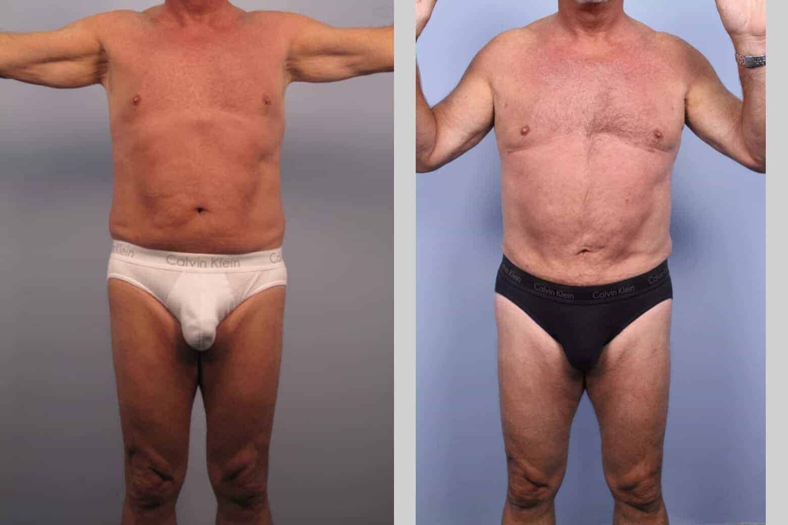 Male Tummy Tuck - Before and After Gallery - Patient Photo 34