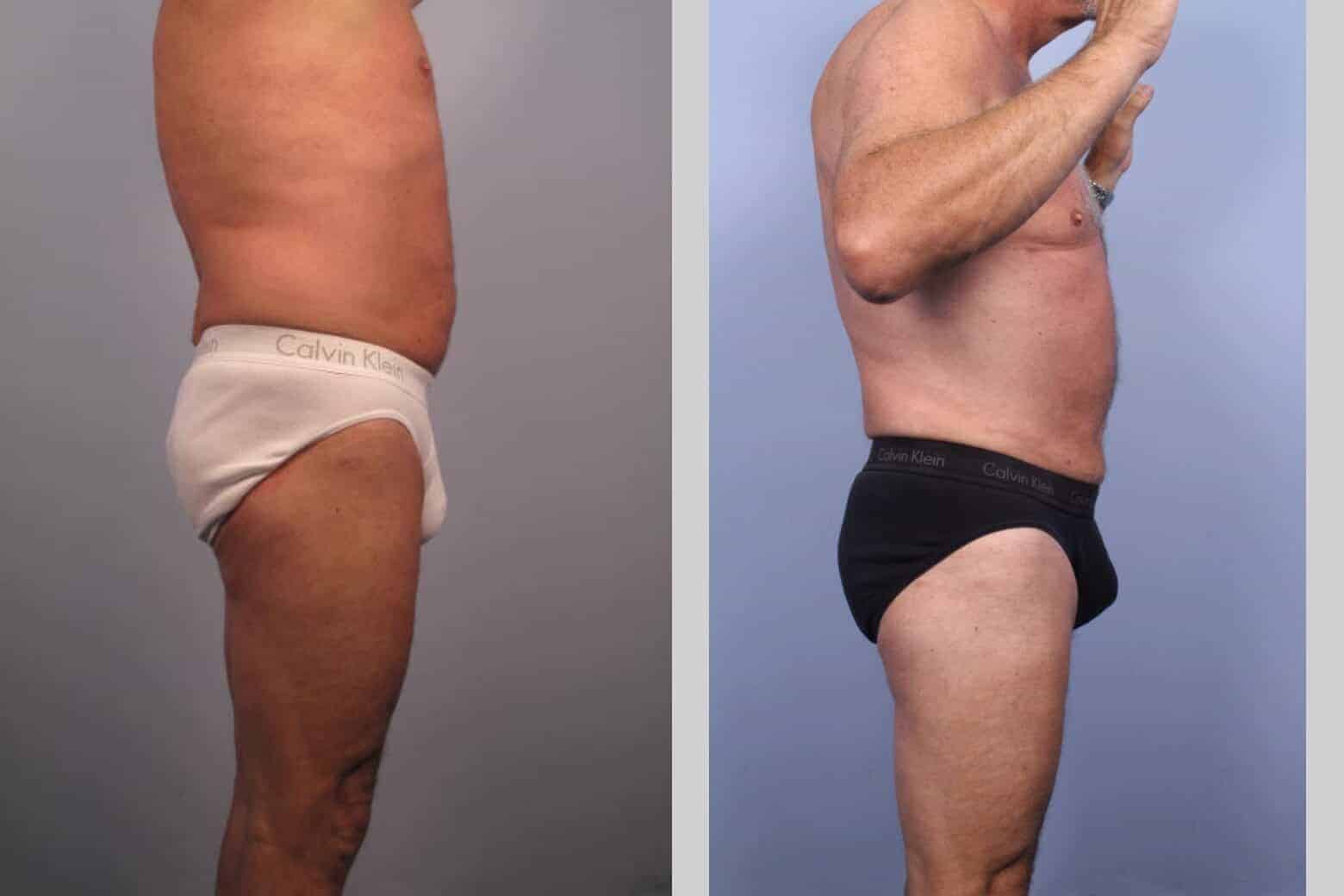 Male Tummy Tuck - Before and After Gallery - Patient Photo 37