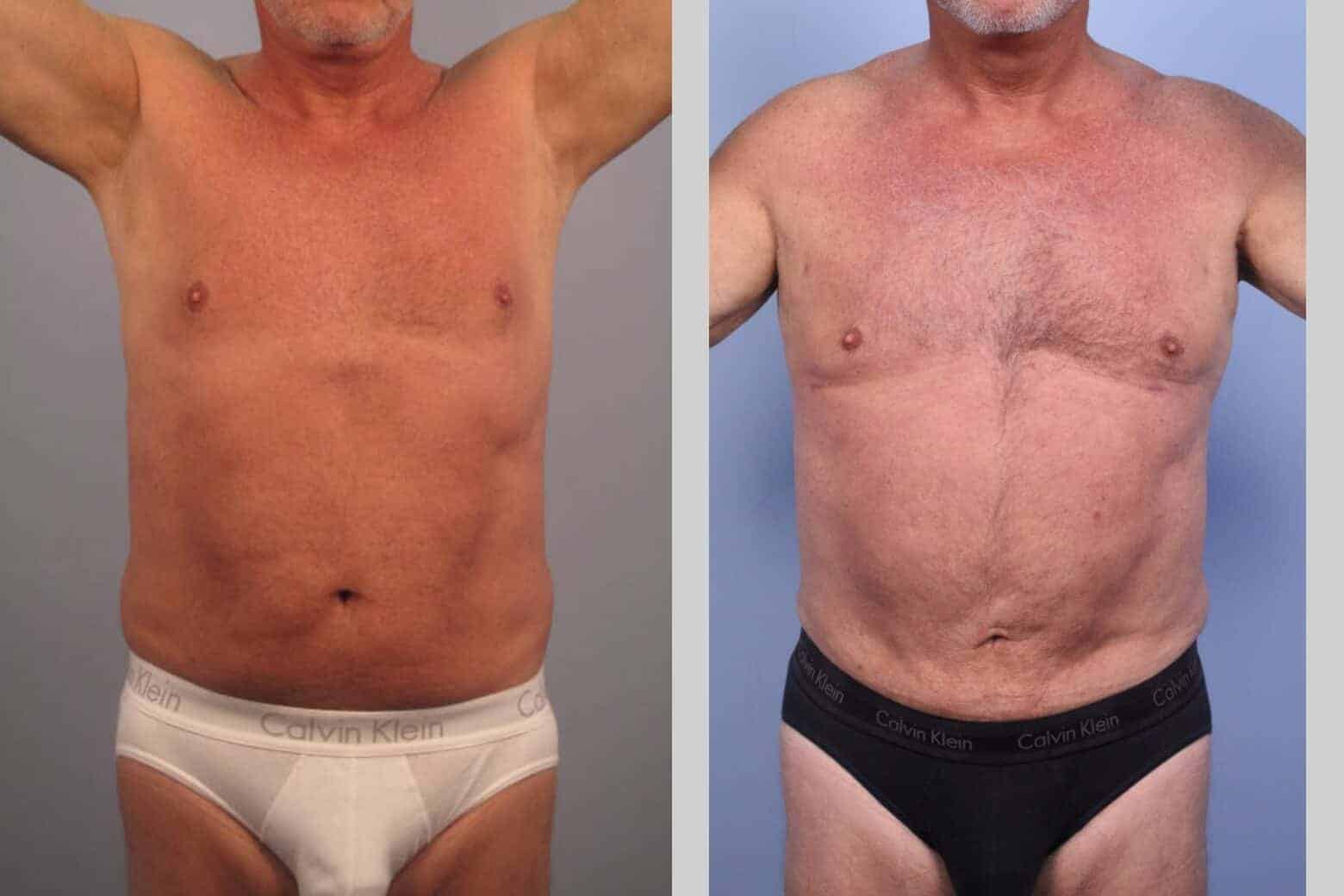 Male Tummy Tuck - Before and After Gallery - Patient Photo 38