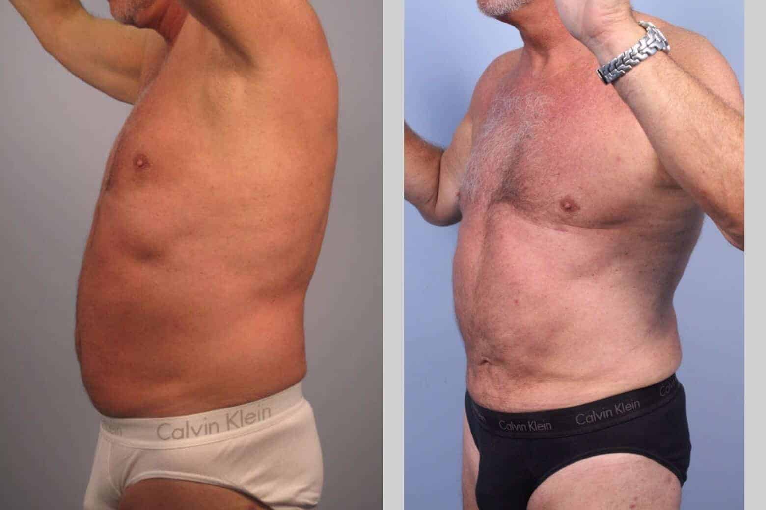 Male Tummy Tuck - Before and After Gallery - Patient Photo 39