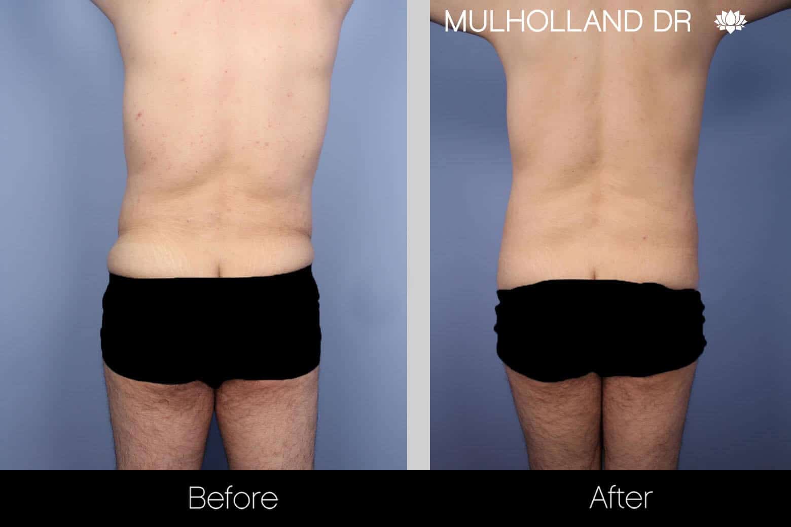 Male Tummy Tuck - Before and After Gallery - Patient Photo 4
