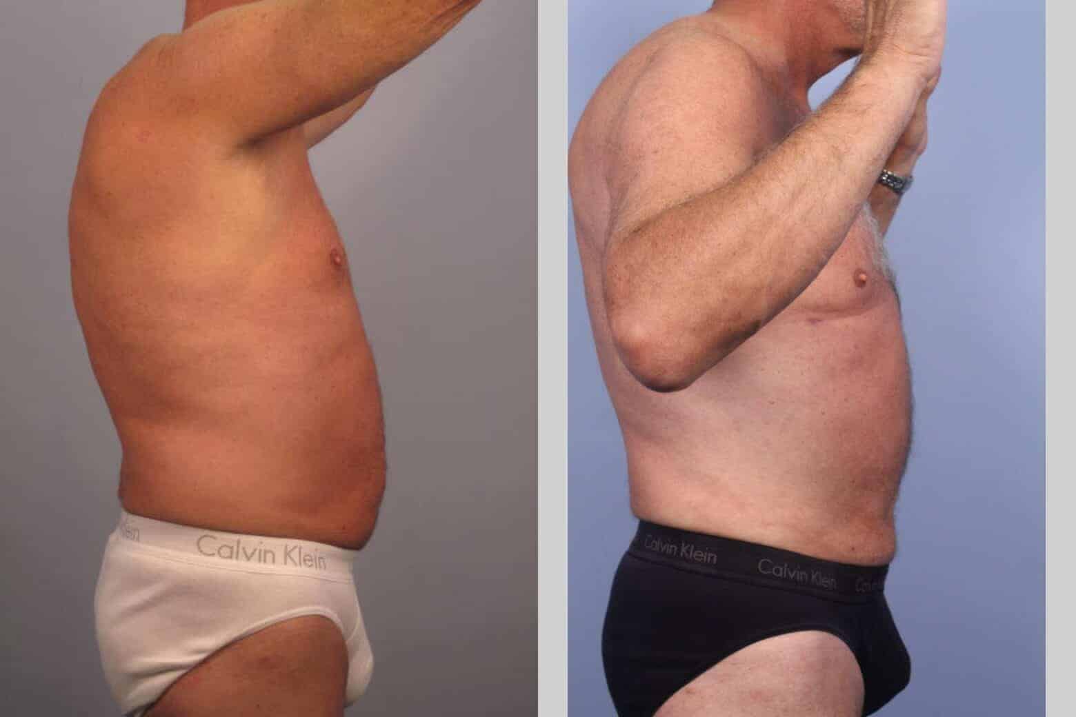Male Tummy Tuck - Before and After Gallery - Patient Photo 40