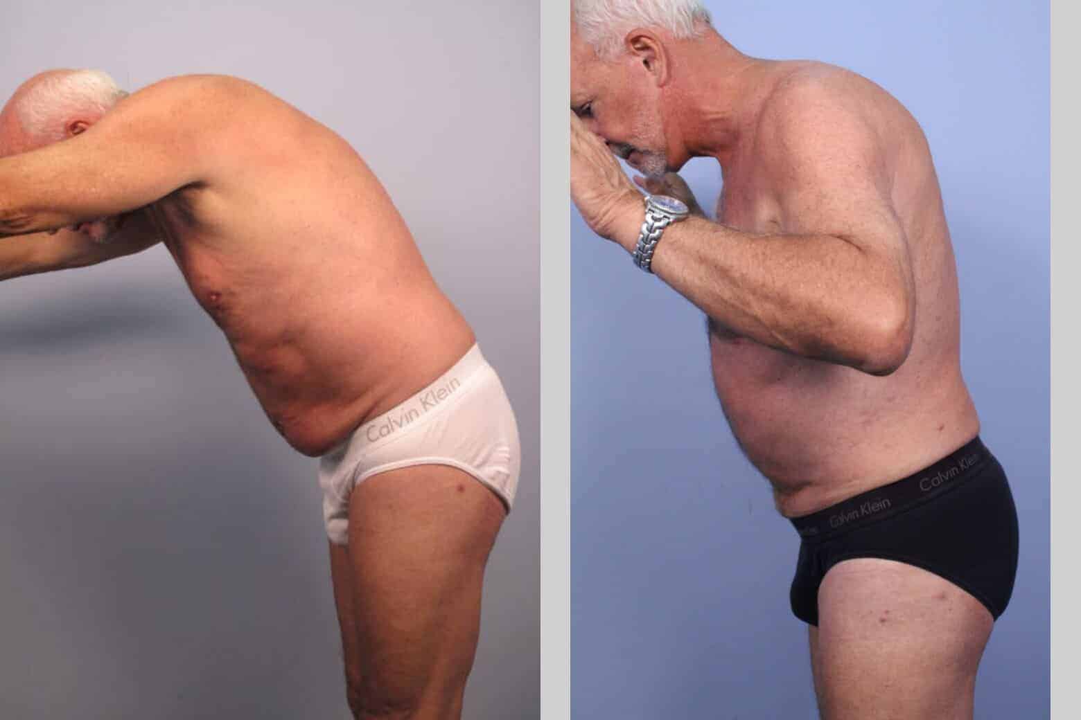 Male Tummy Tuck - Before and After Gallery - Patient Photo 41