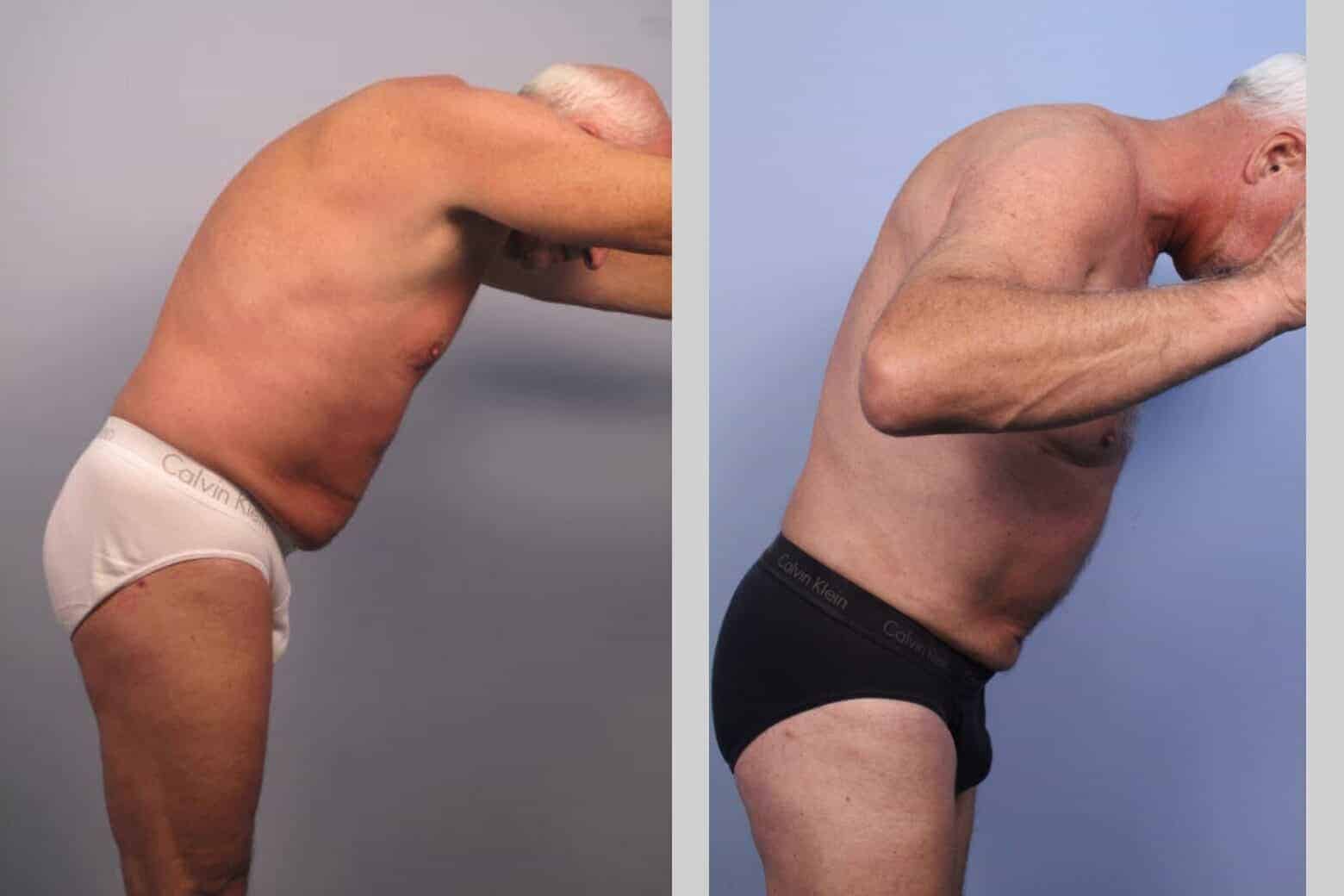 Male Tummy Tuck - Before and After Gallery - Patient Photo 42