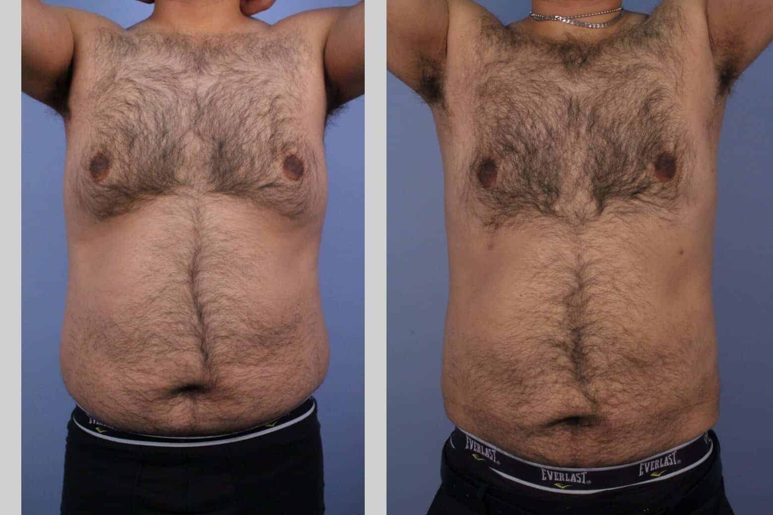 Male Tummy Tuck - Before and After Gallery - Patient Photo 43