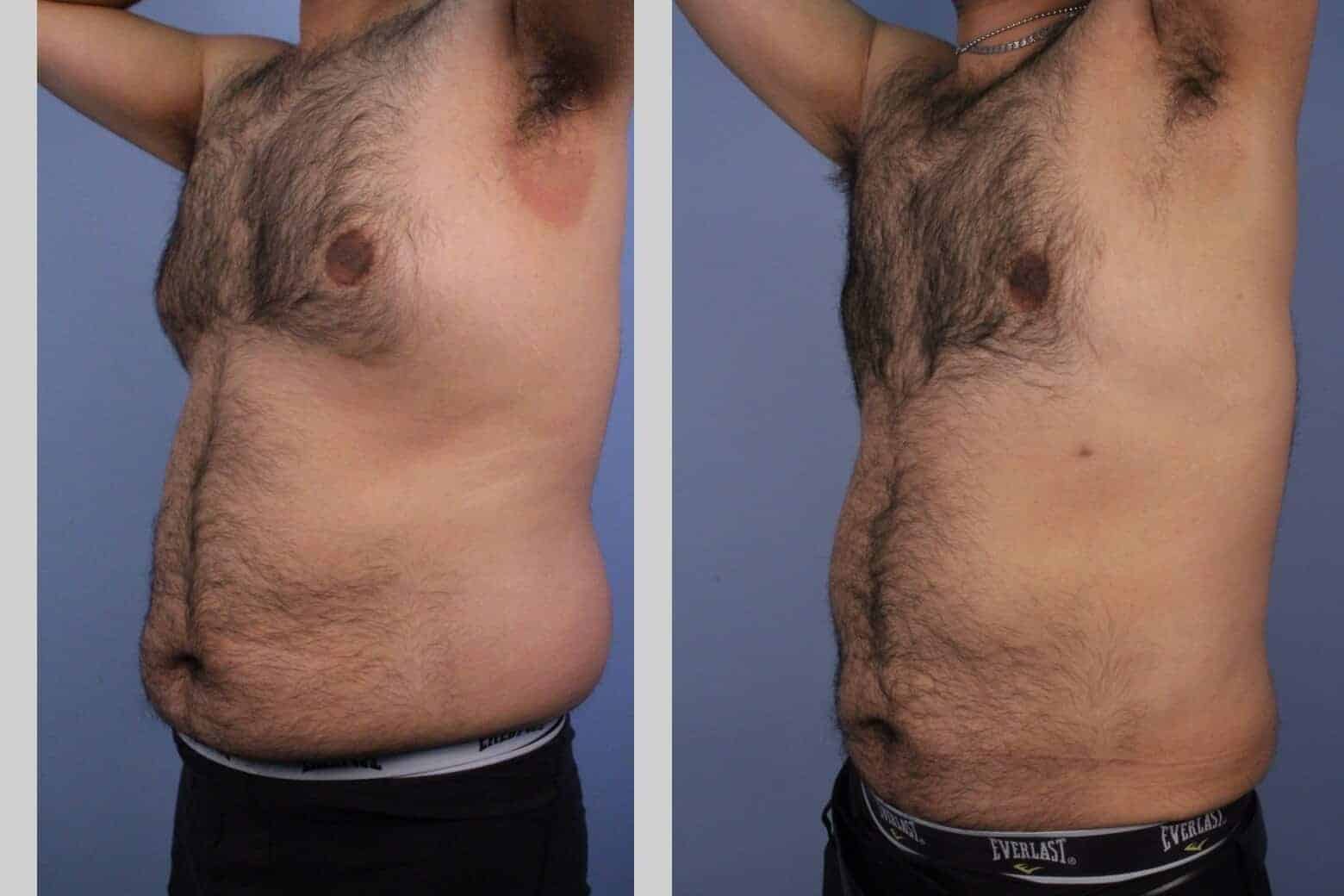 Male Tummy Tuck - Before and After Gallery - Patient Photo 44