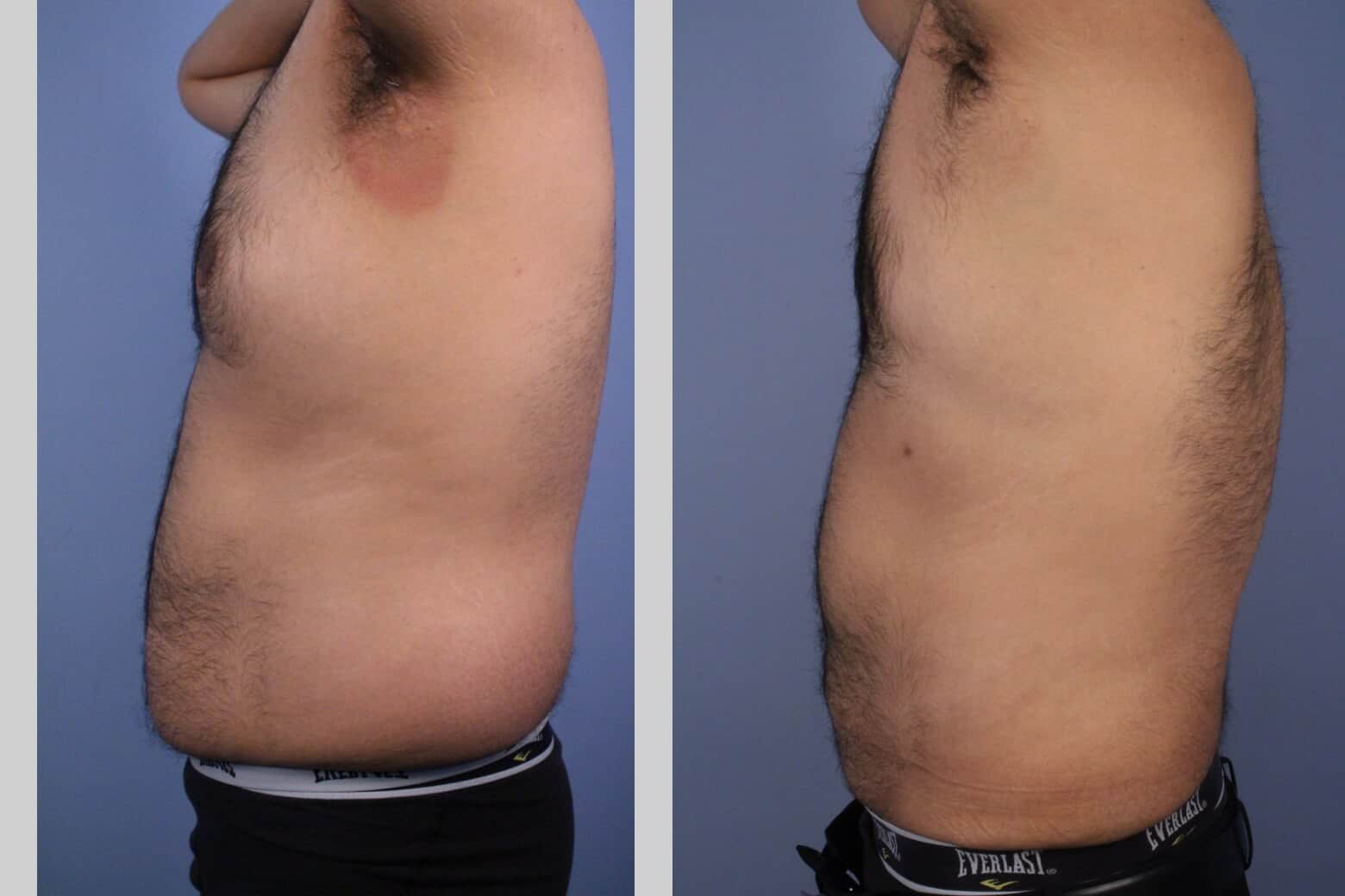Male Tummy Tuck - Before and After Gallery - Patient Photo 45