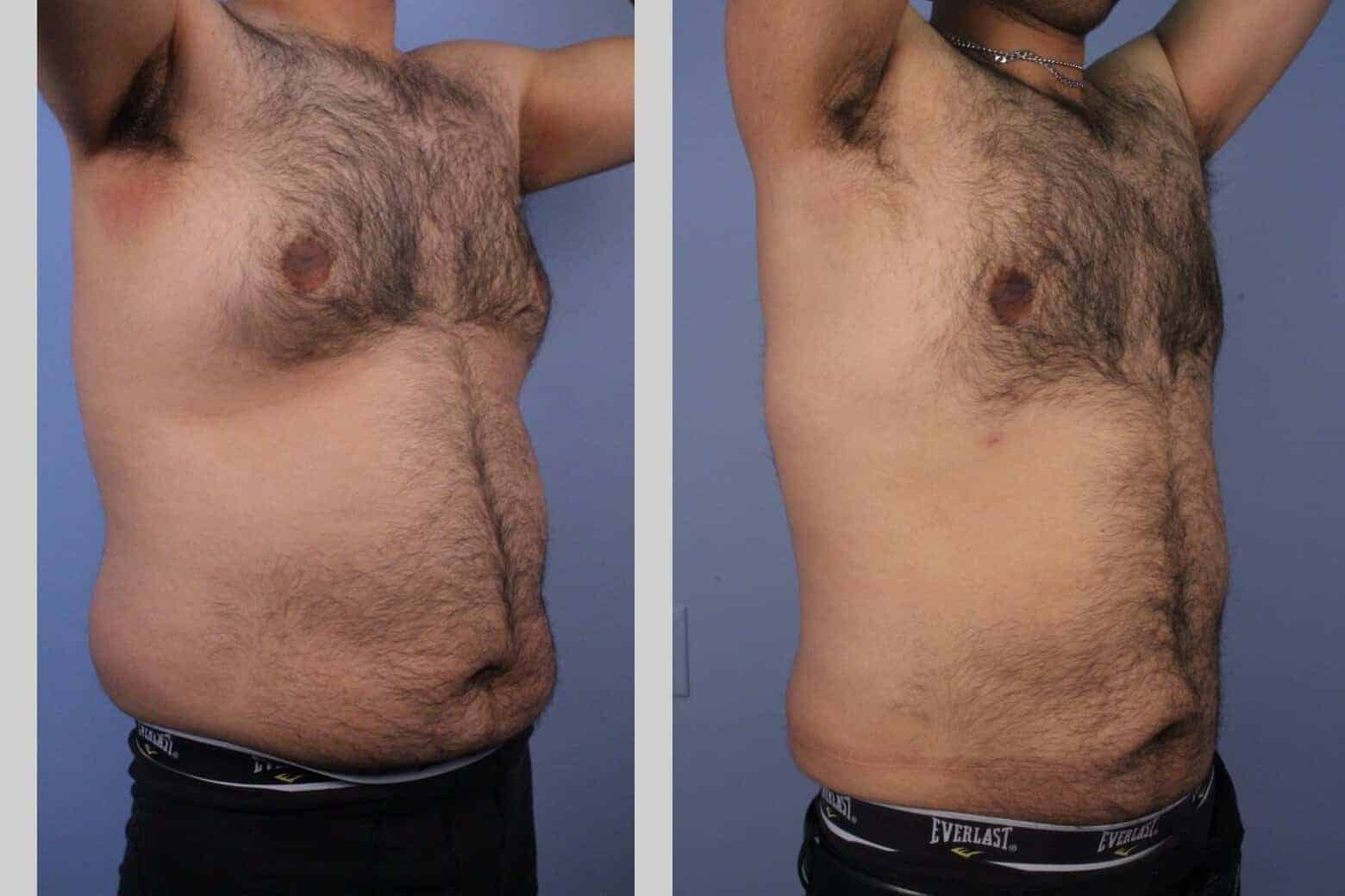 Male Tummy Tuck - Before and After Gallery - Patient Photo 46