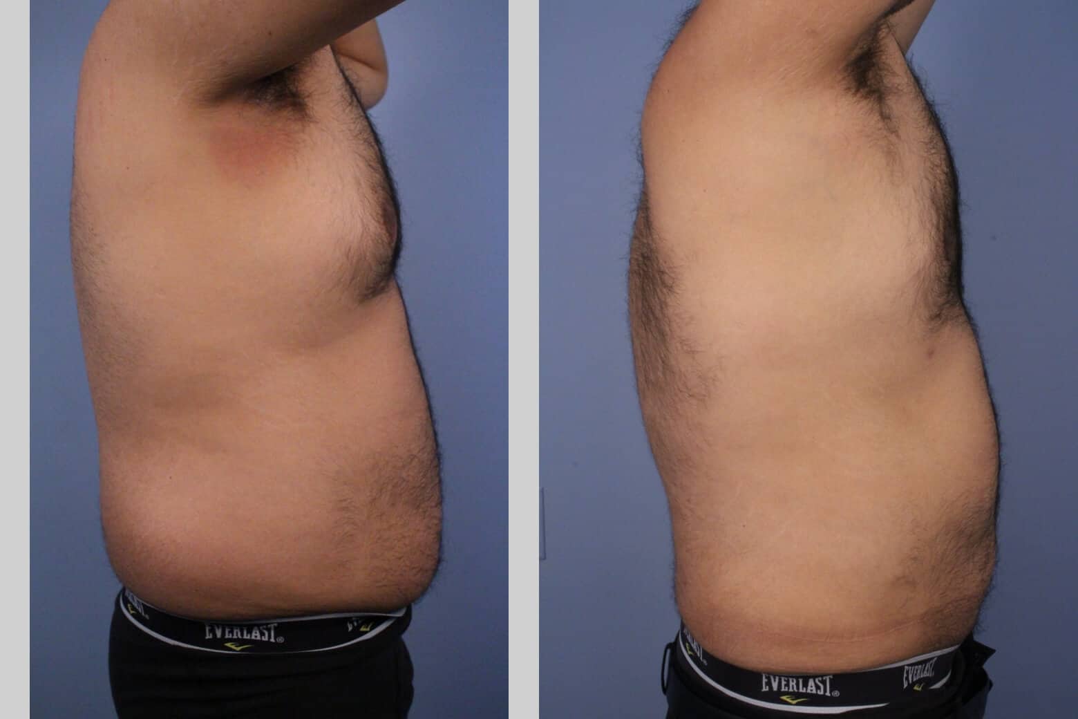 Male Tummy Tuck - Before and After Gallery - Patient Photo 47a