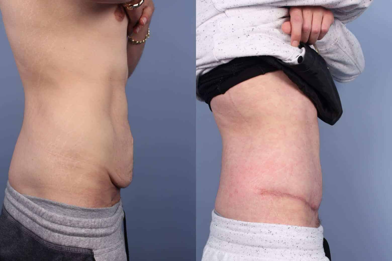 Male Tummy Tuck - Before and After Gallery - Patient Photo 48