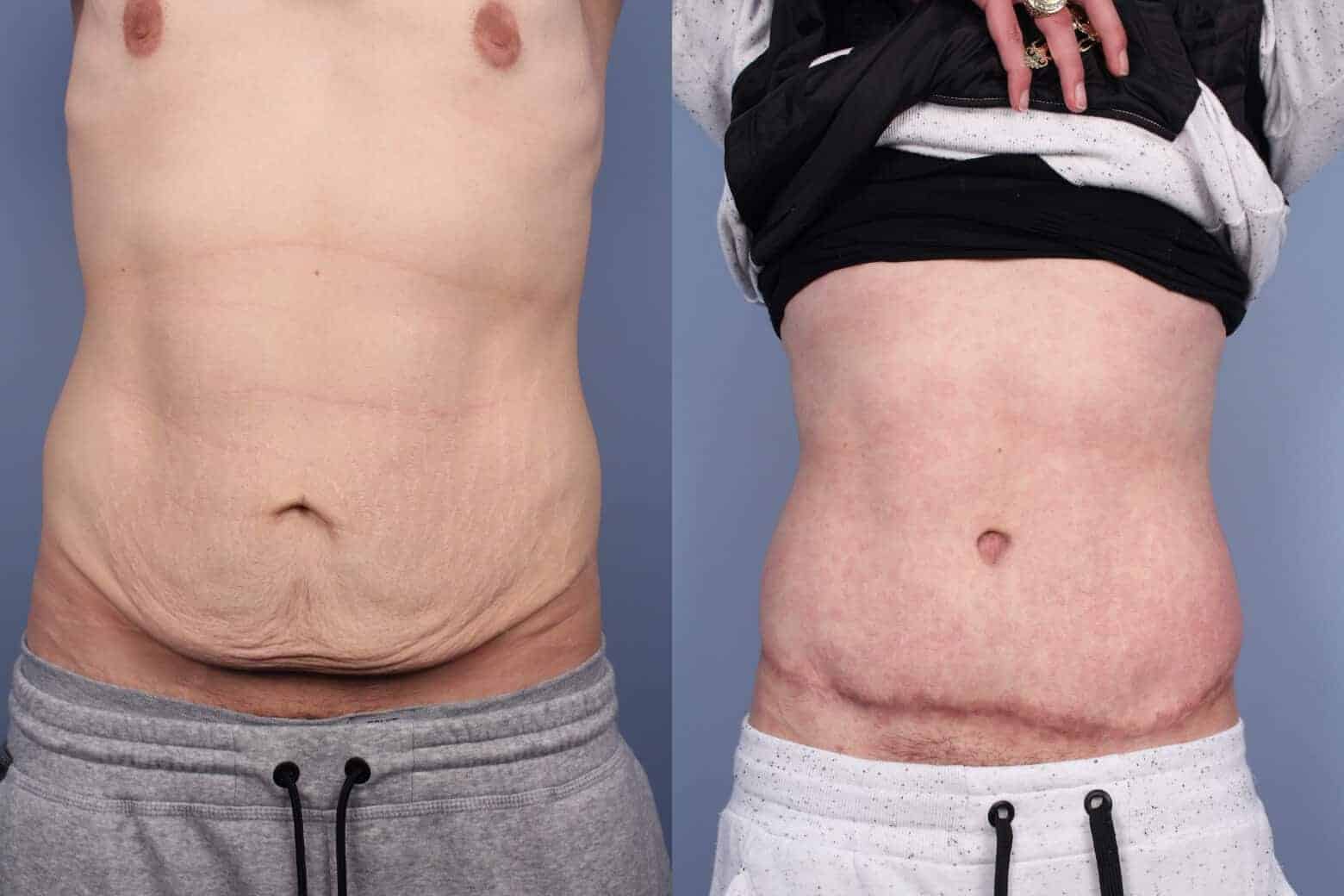 Male Tummy Tuck - Before and After Gallery - Patient Photo 49