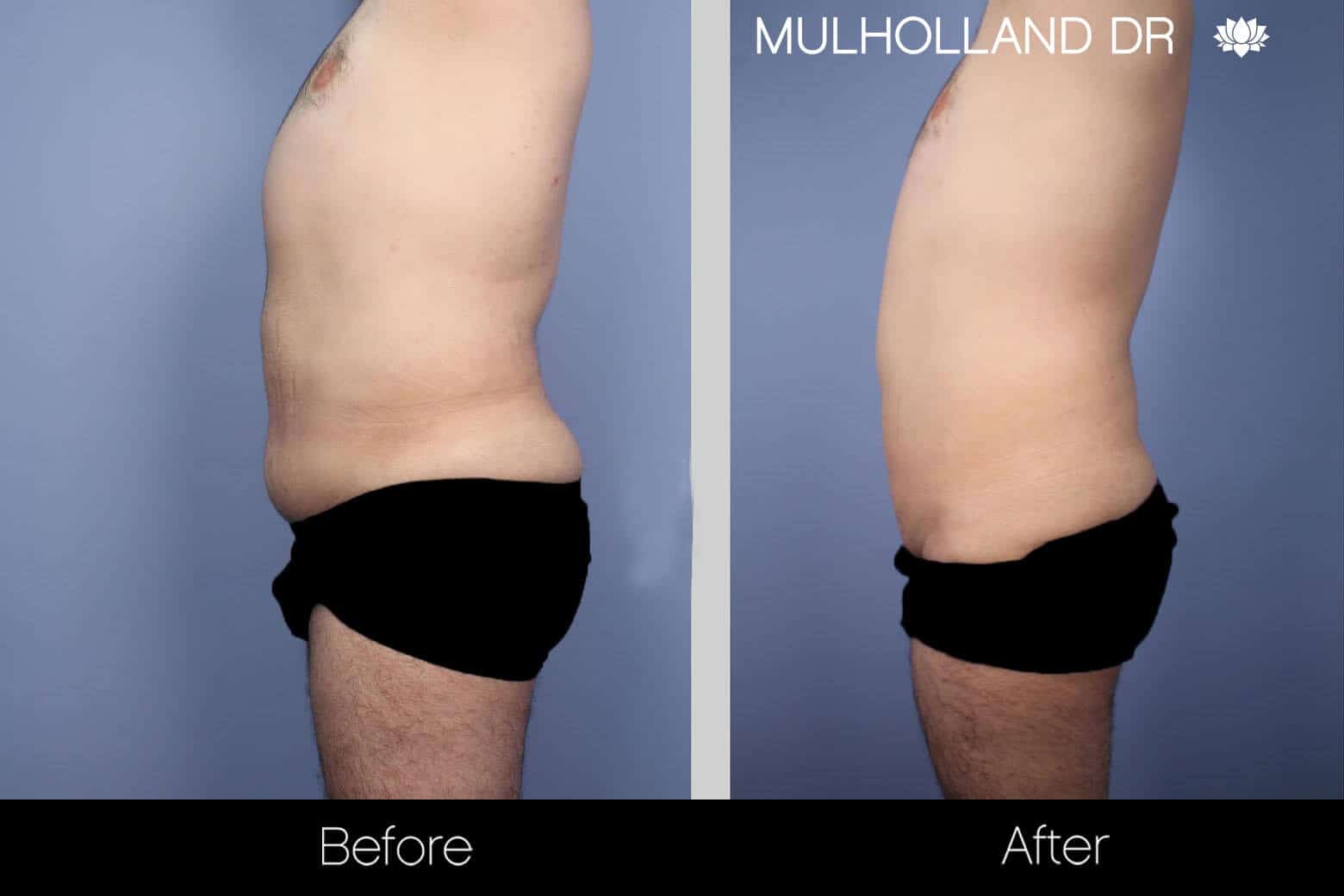 Male Tummy Tuck - Before and After Gallery - Patient Photo 5