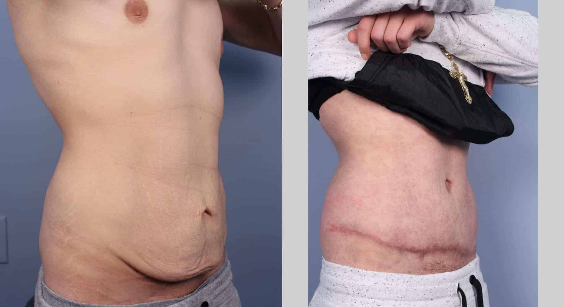 Male Tummy Tuck - Before and After Gallery - Patient Photo 53