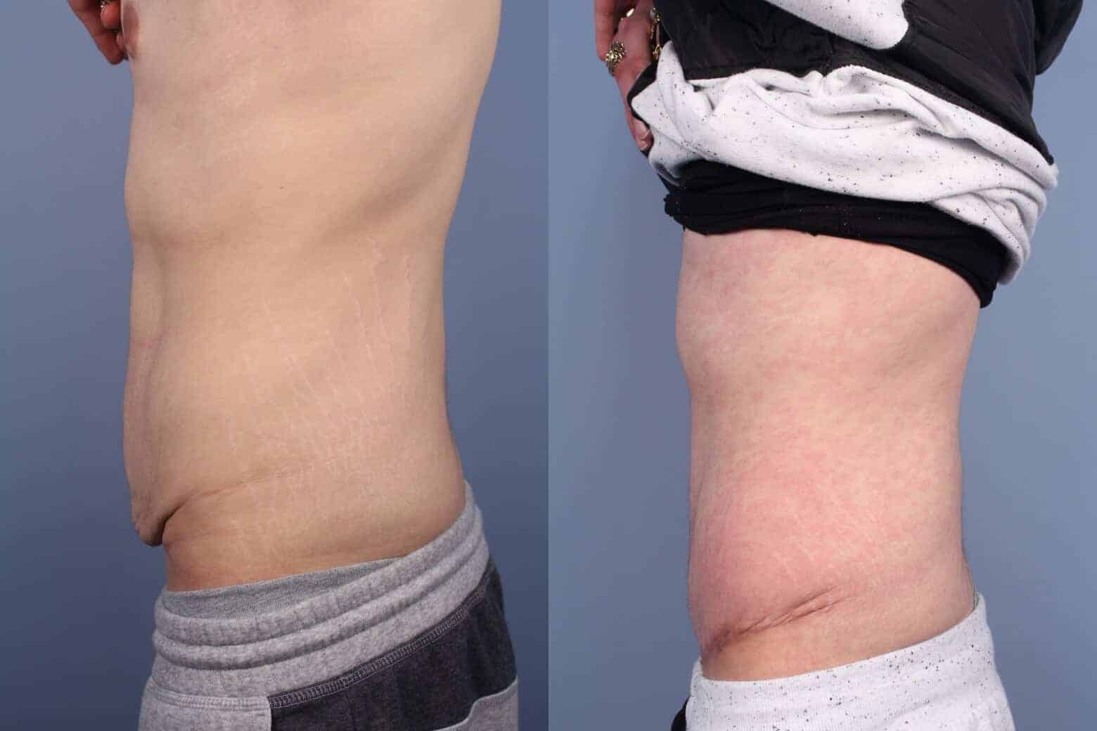 Male Tummy Tuck - Before and After Gallery - Patient Photo 54