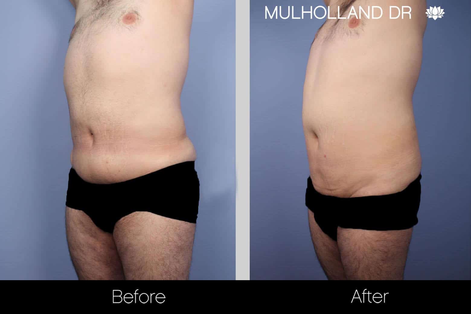 Male Tummy Tuck - Before and After Gallery - Patient Photo 6