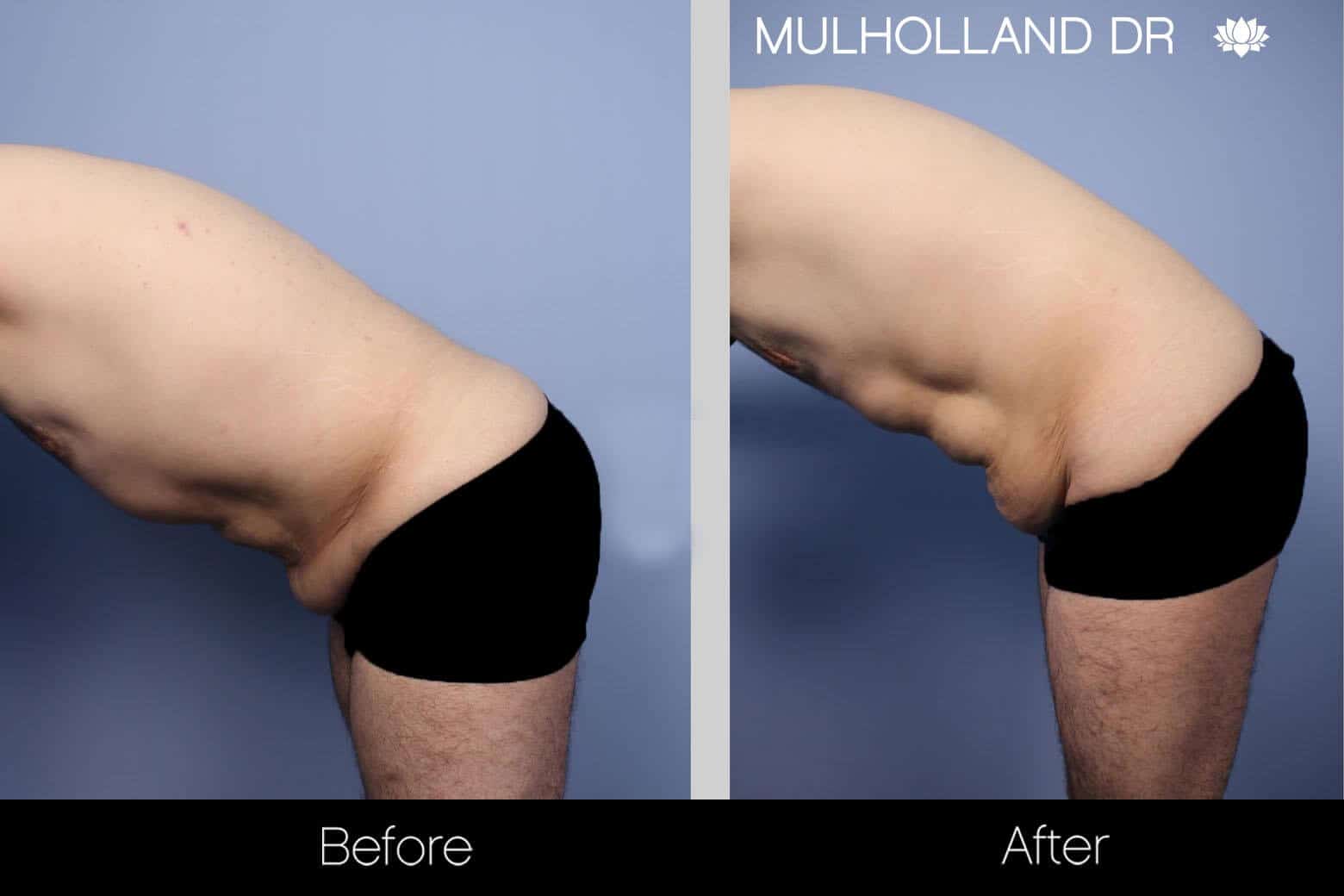 Male Tummy Tuck - Before and After Gallery - Patient Photo 7
