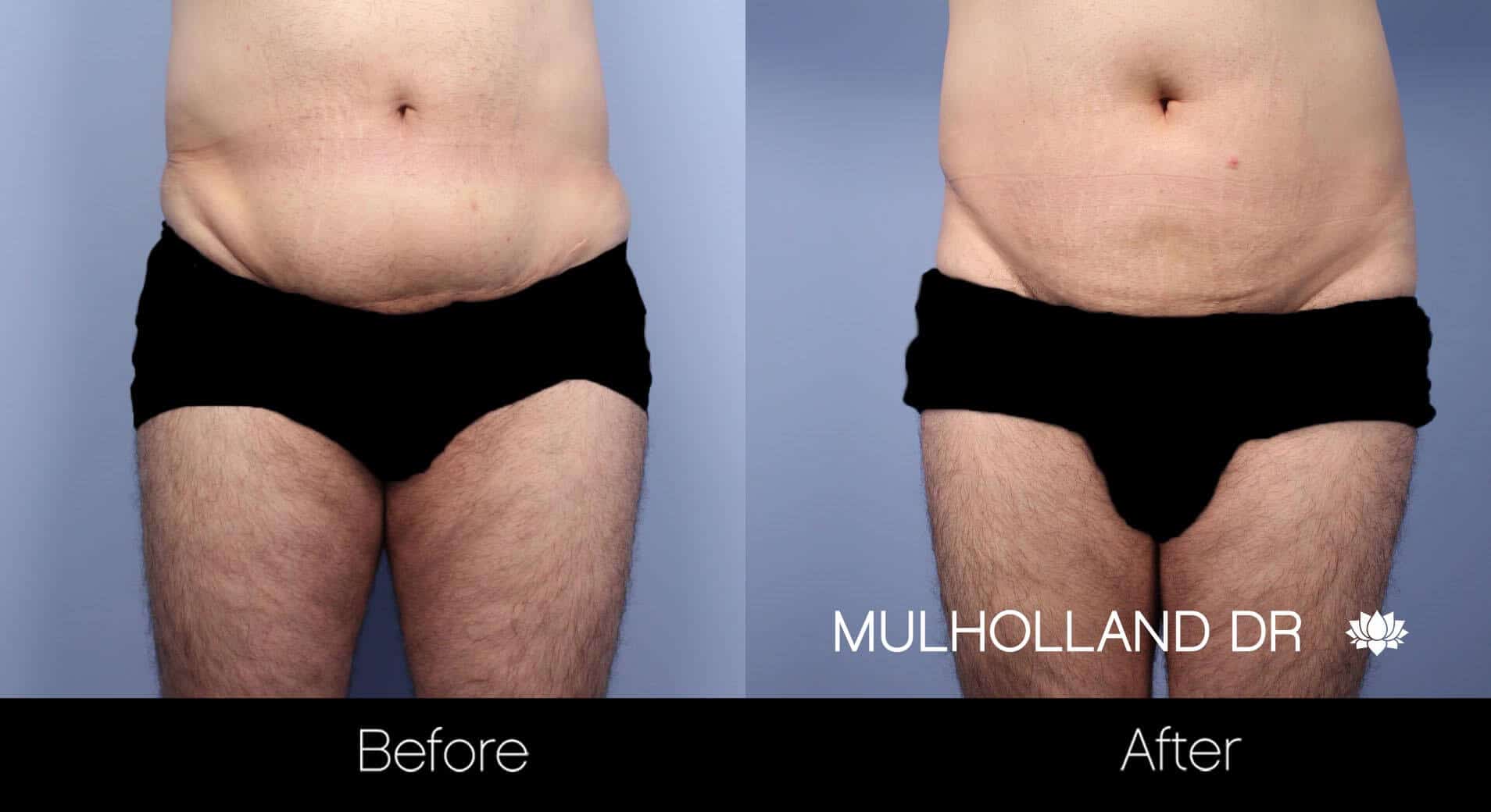 Male Tummy Tuck - Before and After Gallery - Patient Photo 9