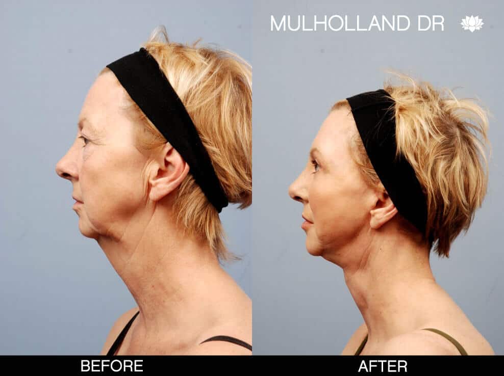 Neck Lift - Before and After Gallery - Patient Photo 1