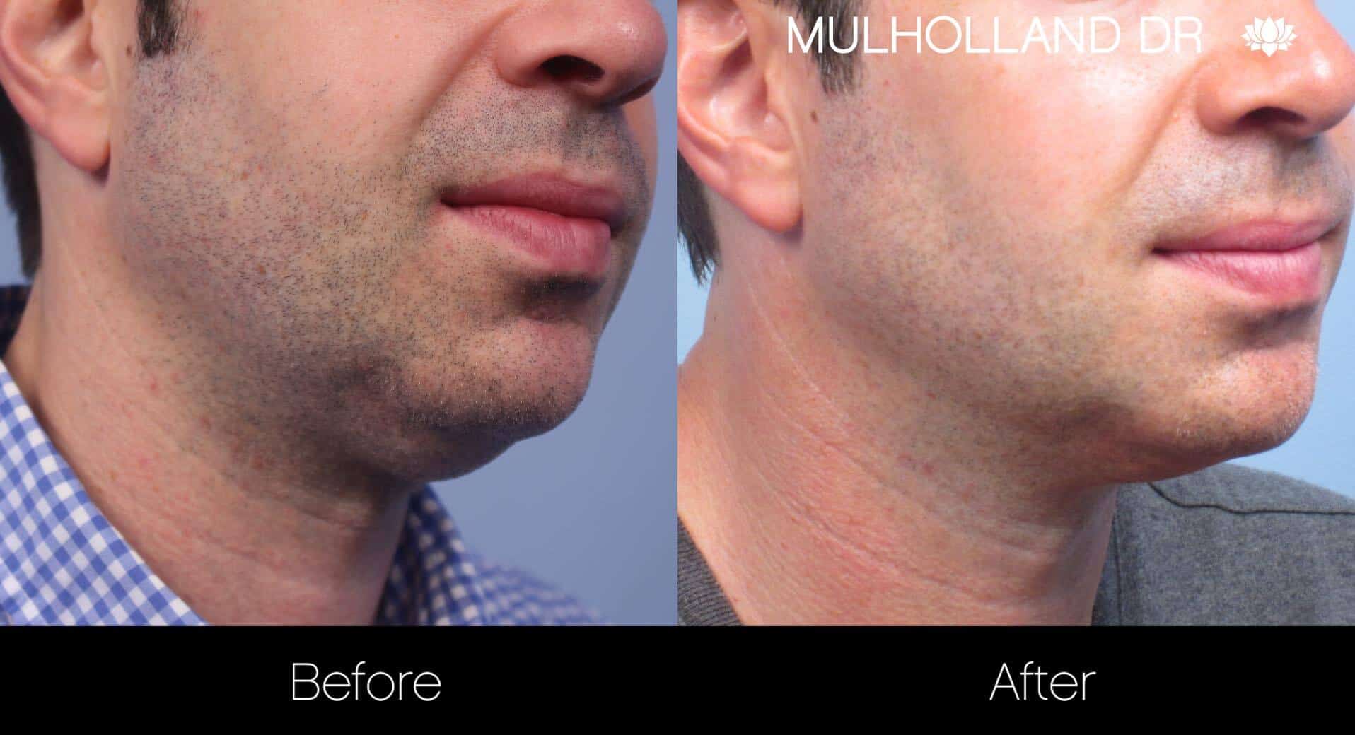 Neck Lift - Before and After Gallery - Patient Photo 102