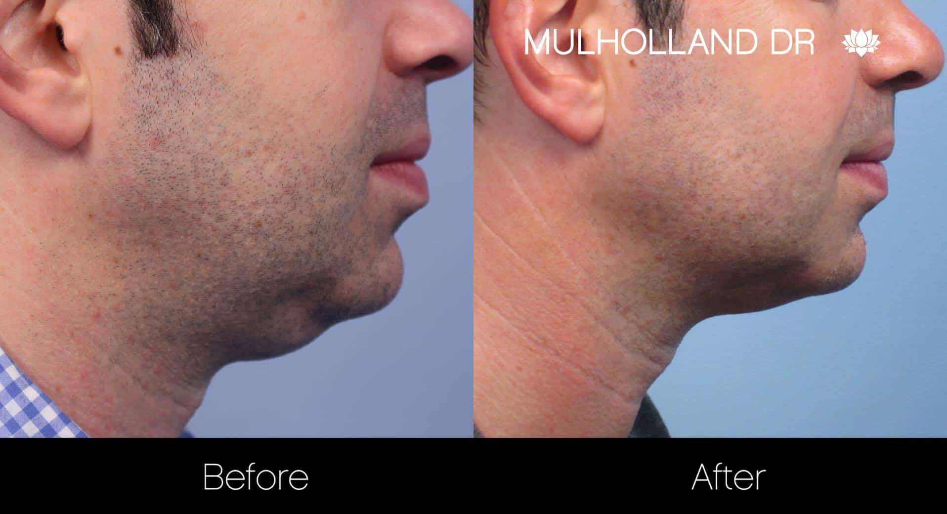 Neck Lift - Before and After Gallery - Patient Photo 103